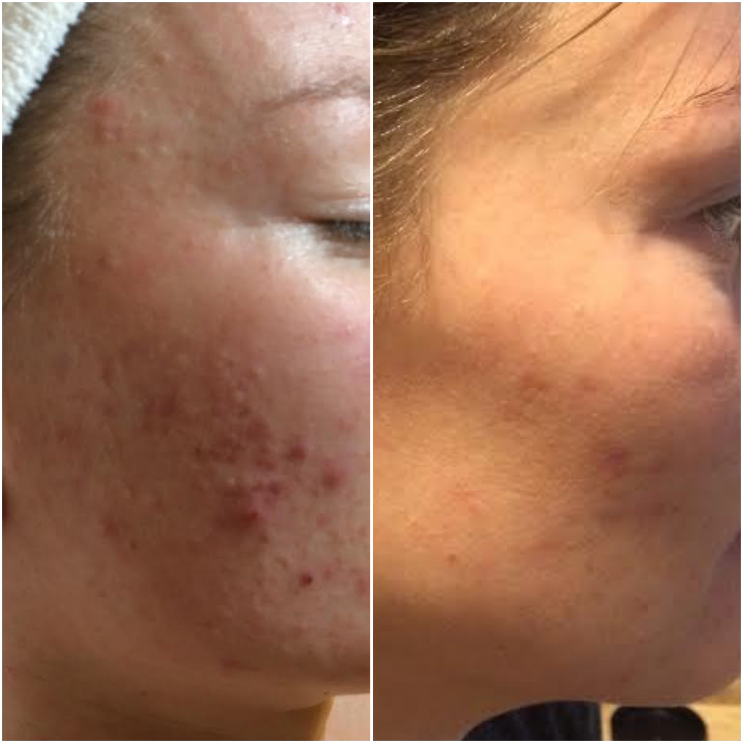   Cystic acne cleared using NŪR hi-tech facial series  