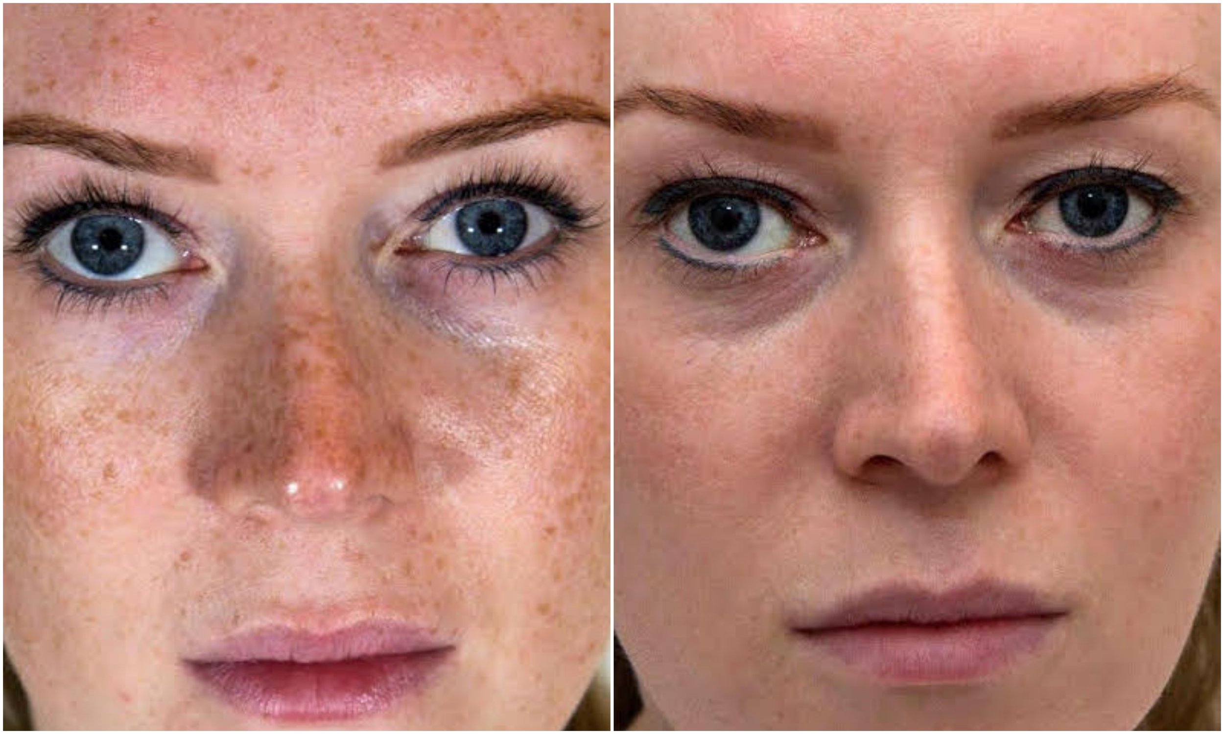   Freckles removed, even skin tone achieved using Perfect Derma Peel (Intense Peel)  