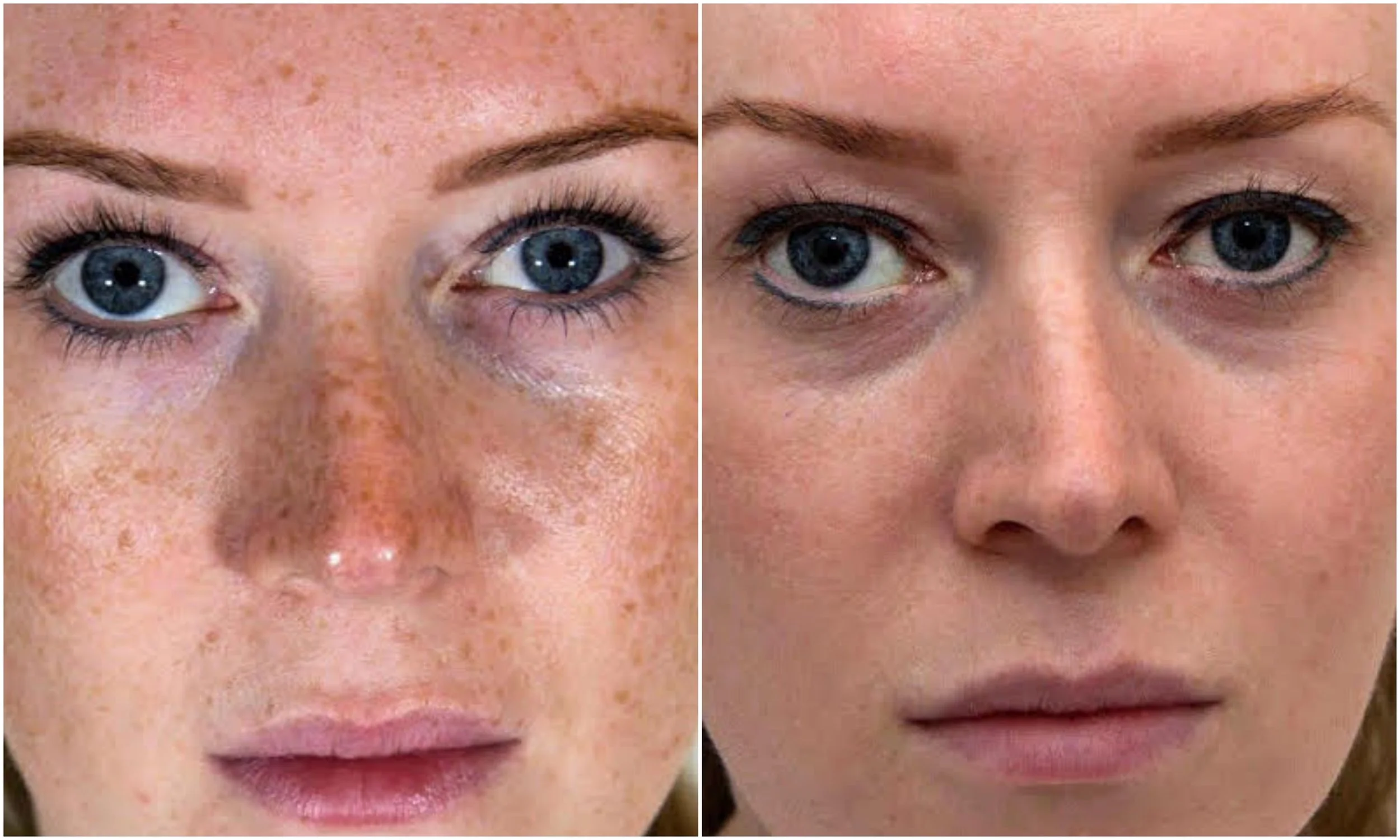 Freckles removed, even skin tone achieved using Perfect Derma Peel (Intense Peel)