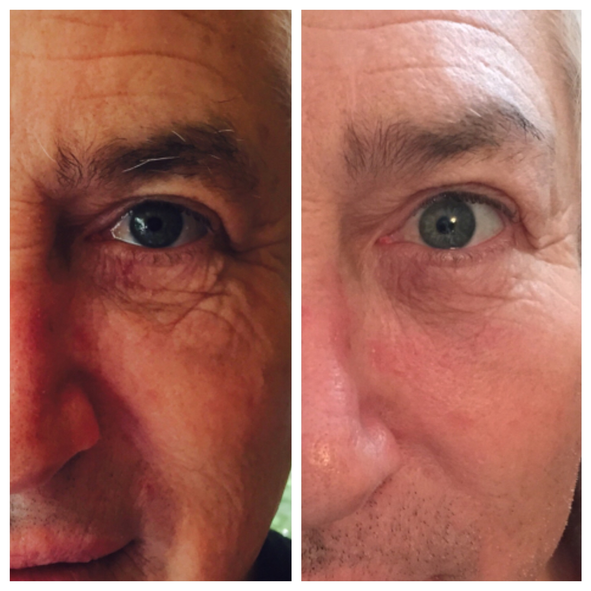   Tone/Texture improved and fine lines filled using Perfect Derma Peel (Intense Peel)  