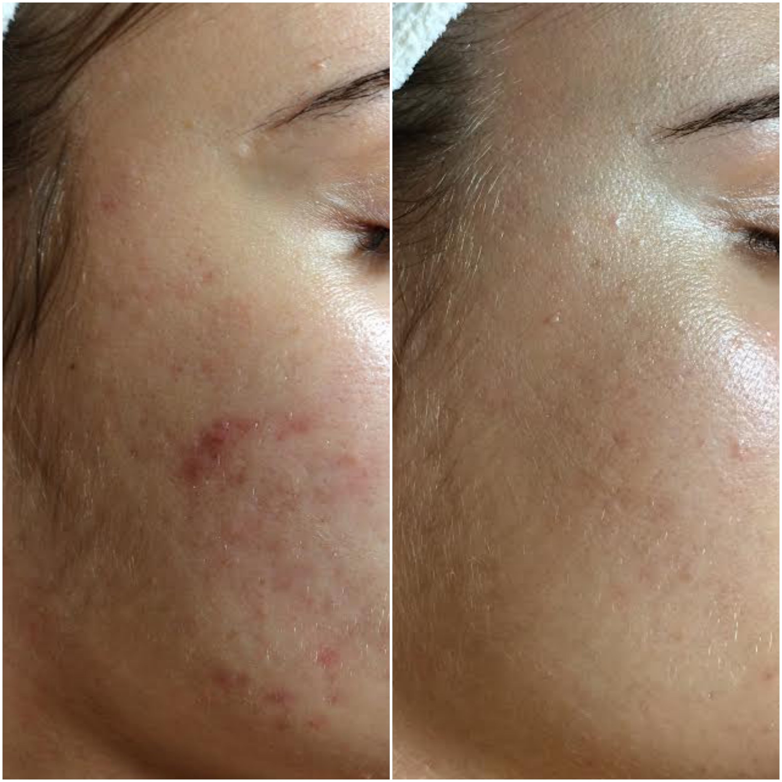   Cystic acne cleared using NŪR hi-tech facial series  