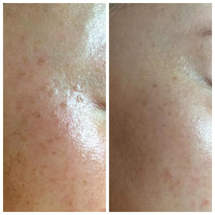 Moles removed using hyfrecation and NŪR hi-tech facial series