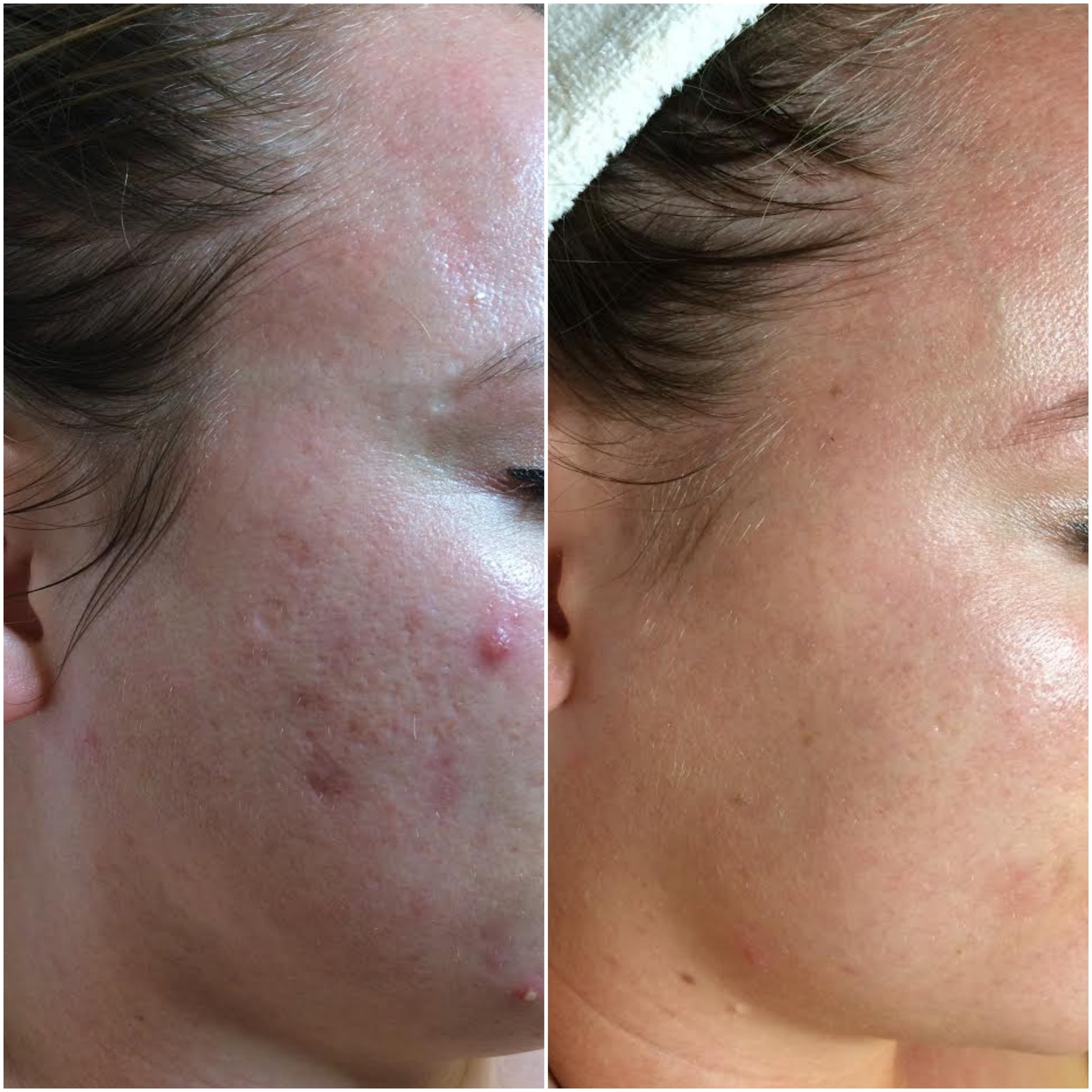   Cystic acne cleared, using NŪR hi-tech facial series  
