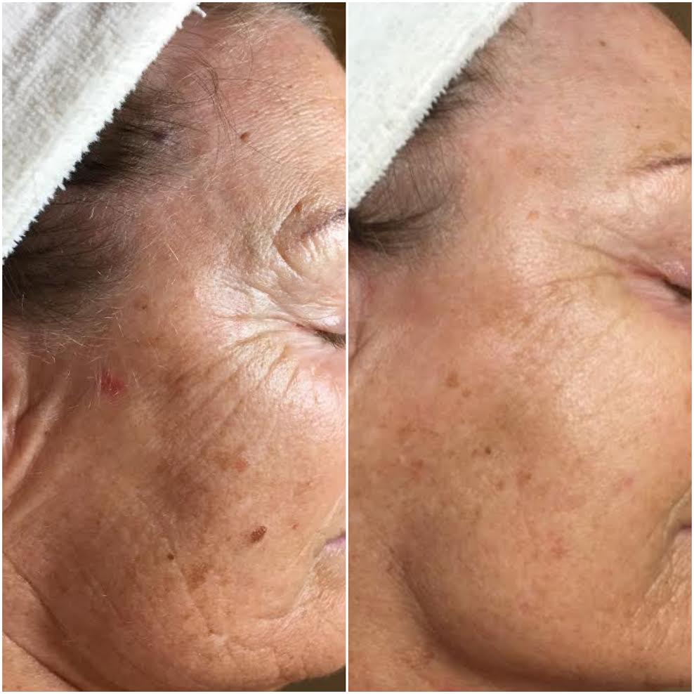   Collagen increased, fine lines filled, blemishes removed using Human Stemcell Microneedling  