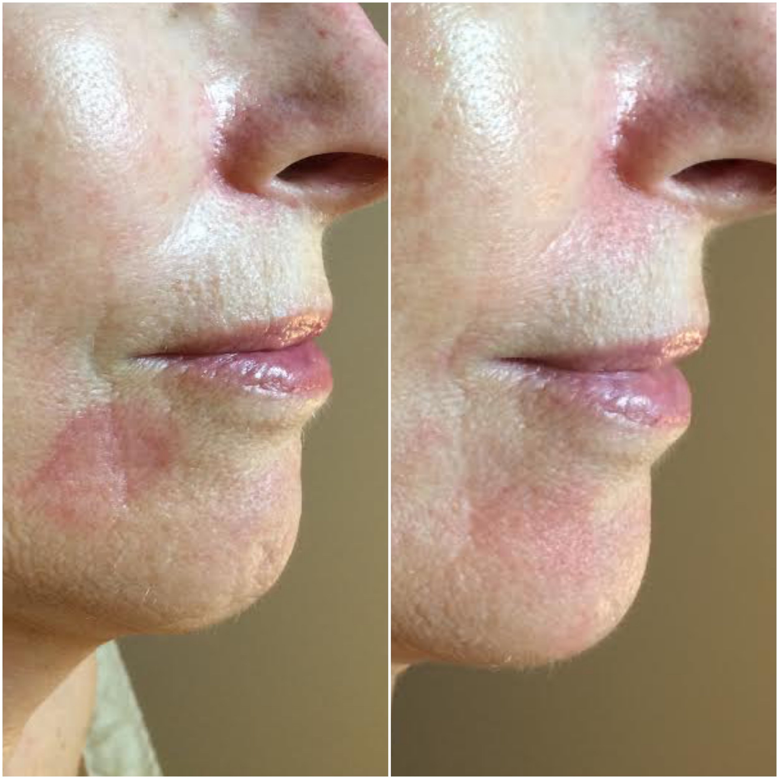   Erythema reduced, fine lines filled using human stem cell microneedling series  