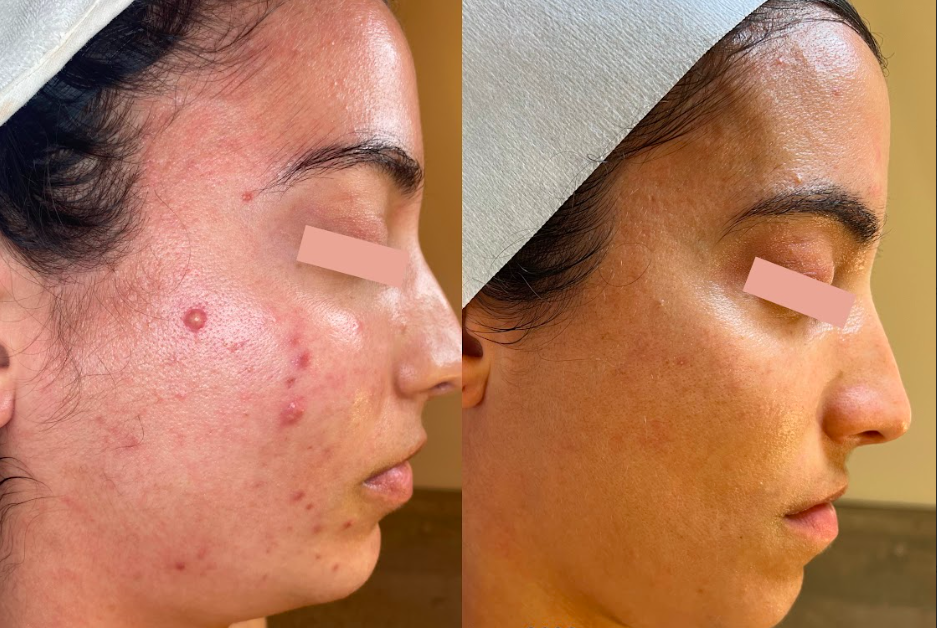  improvement in texture and congestion following a series of 6 (12 step hi-tech facials) + LILAC series 