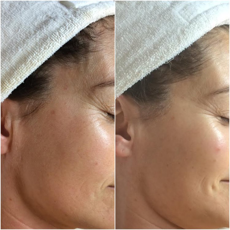  improvement in fine lines following microneedling series  