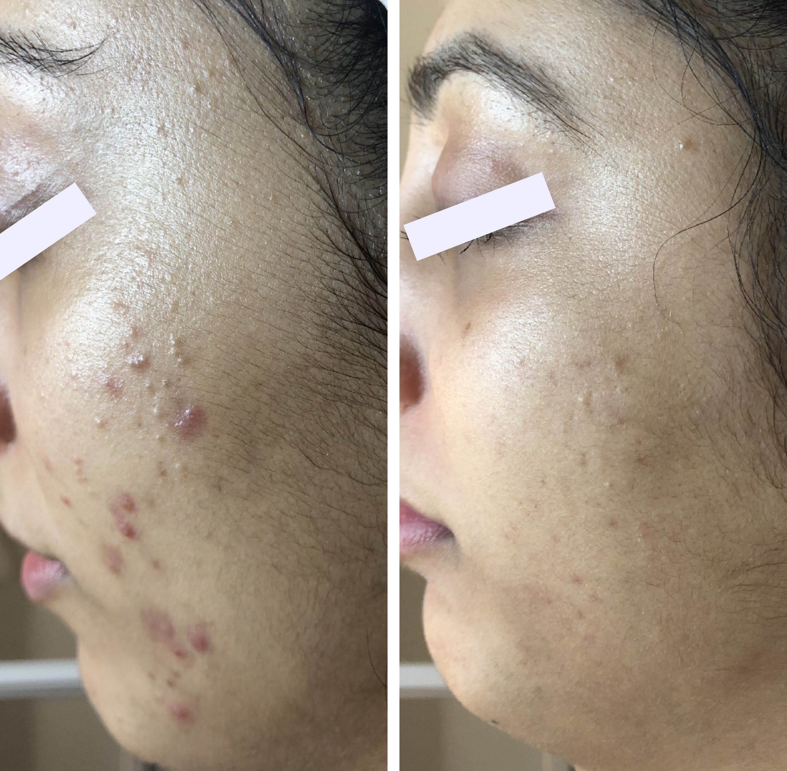  cystic acne cleared following a series of 12 step hi-tech facials 