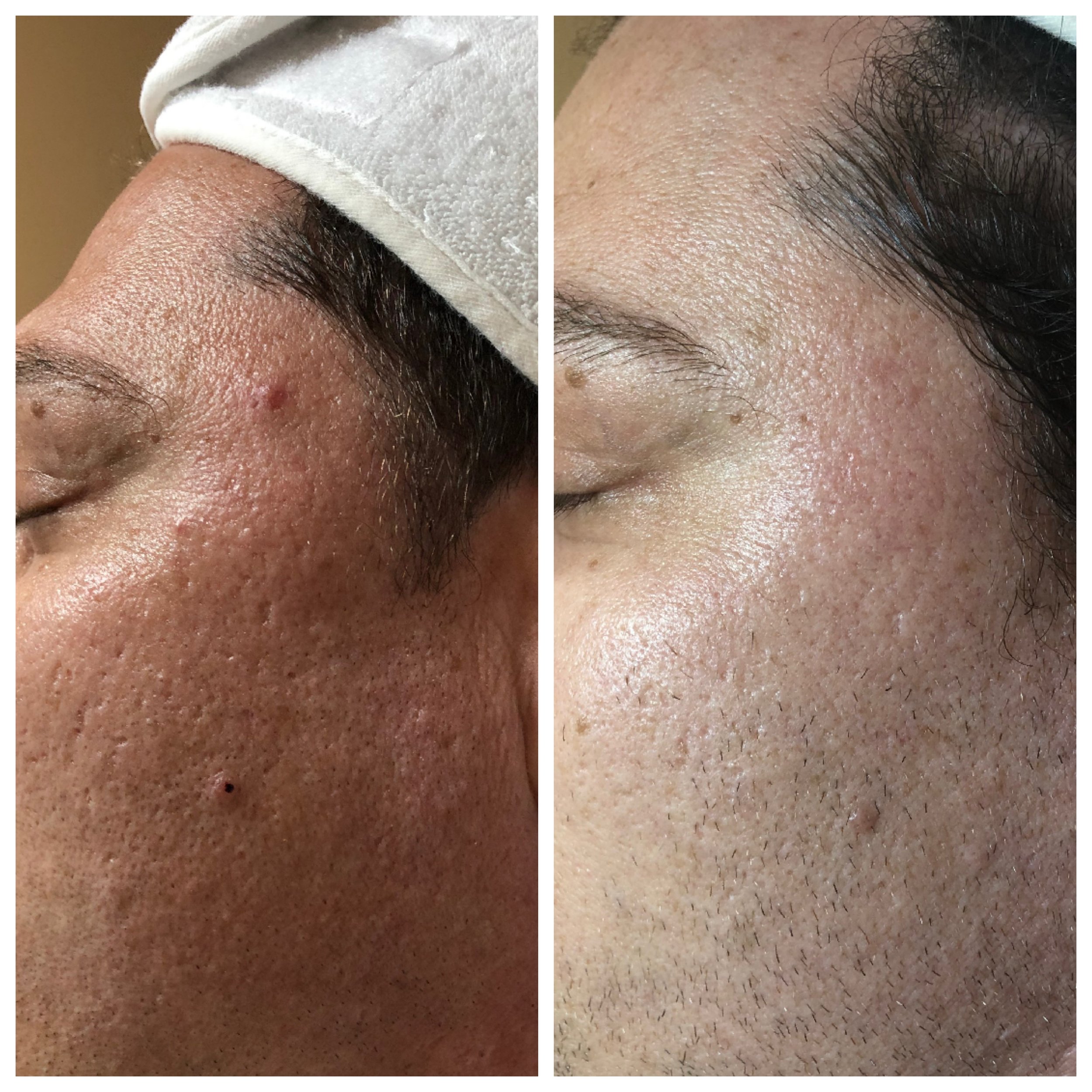  reduction in redness due to promoting blood flow, improvement in texture following a series of microneedling treatments 