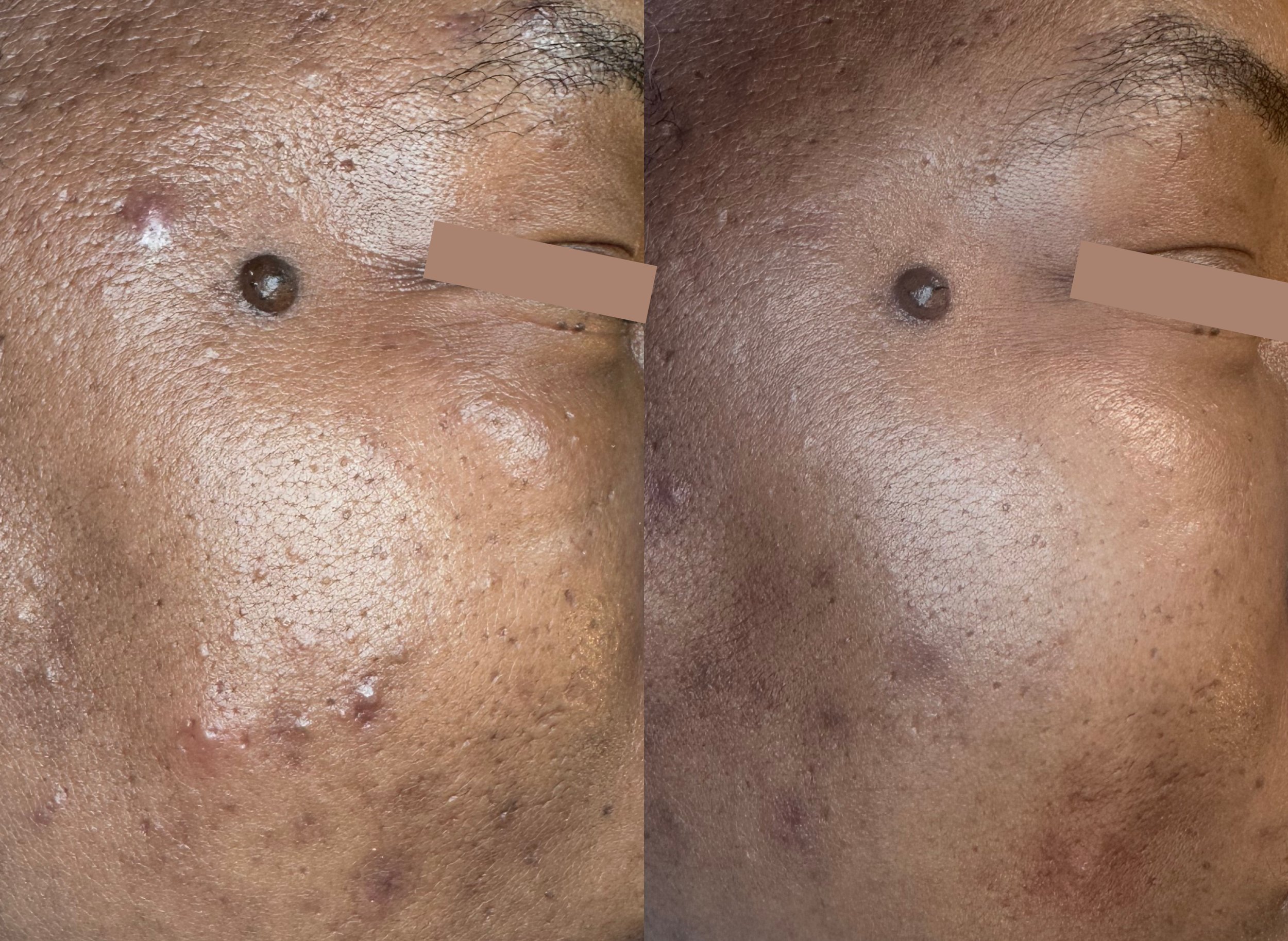  cystic acne cleared following a series of our 12 step-hi tech facials 