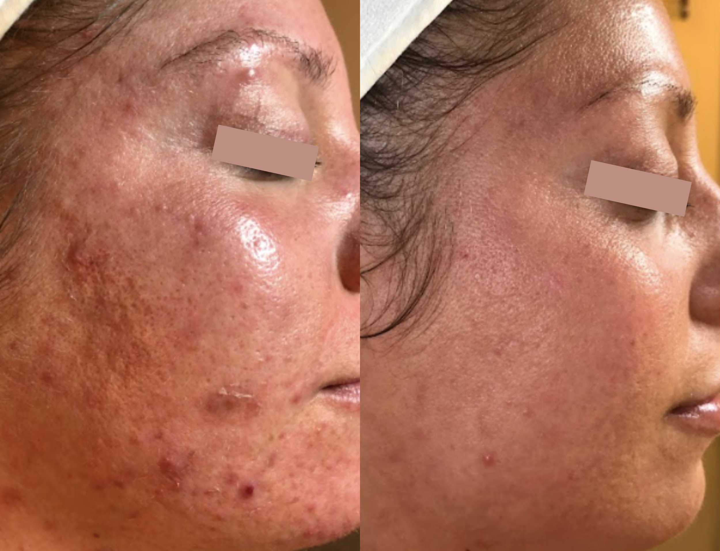  following 12 step + hi tech facials and stem-cell microneedling treatments  