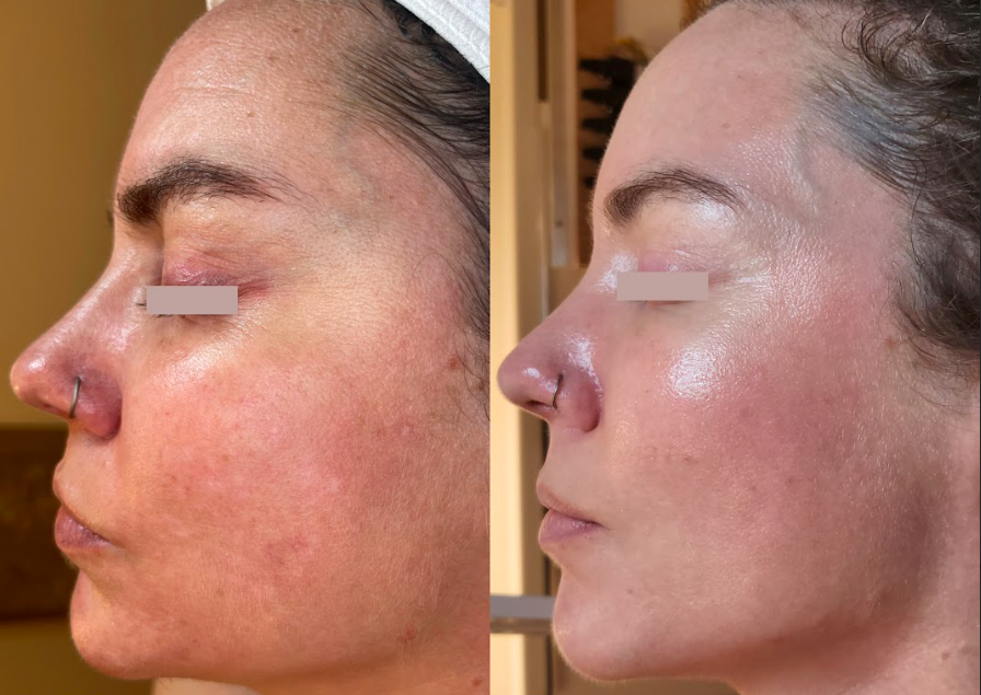  improvement in pigmentation and tone following LILAC program  