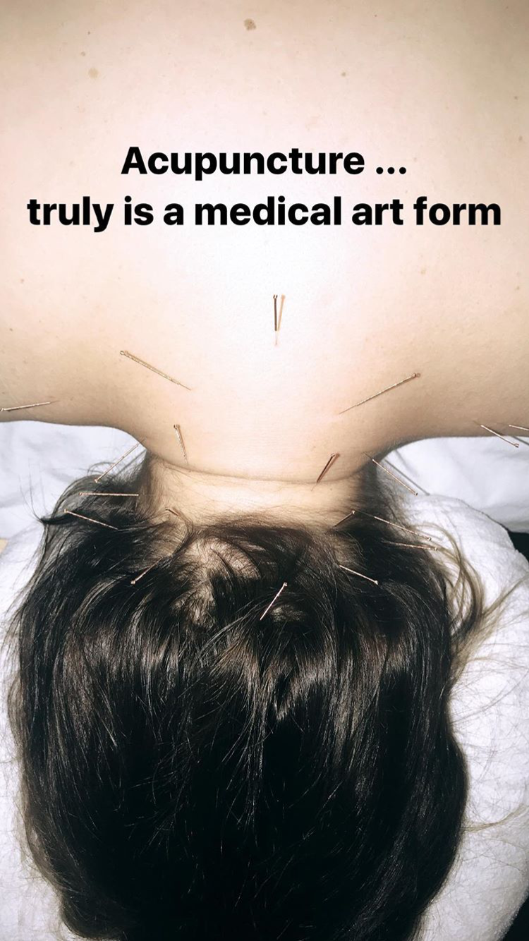 Acupuncture Vancouver - Alla Ozerova - 14.PNG