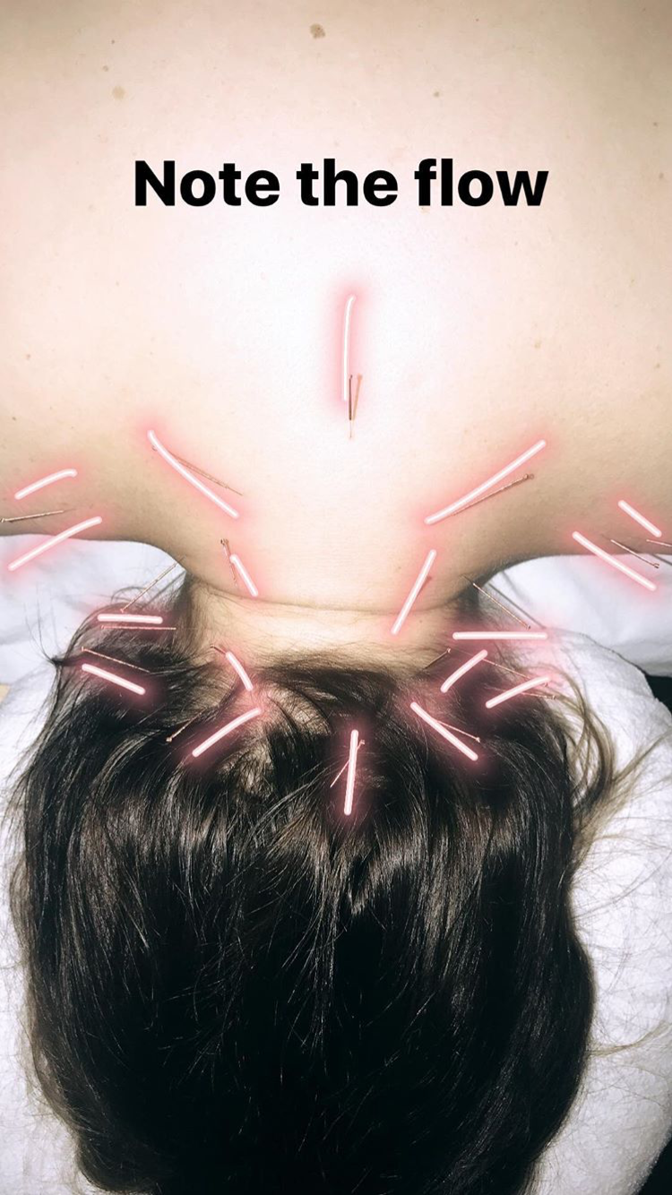 Acupuncture Vancouver - Alla Ozerova - 15.PNG