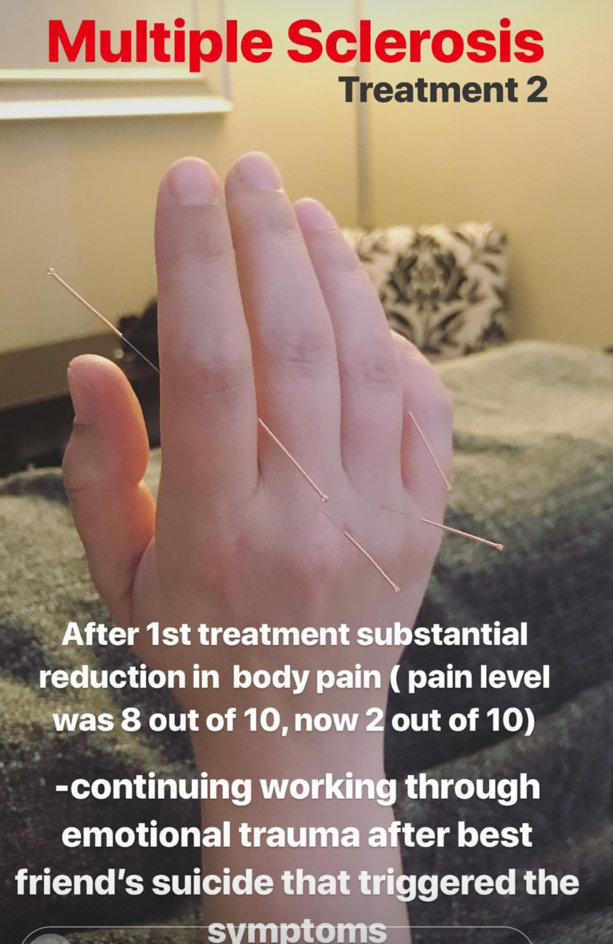  continuation of acupuncture treatment for multiple sclerosis case triggered by personal emotionally stressing events.  