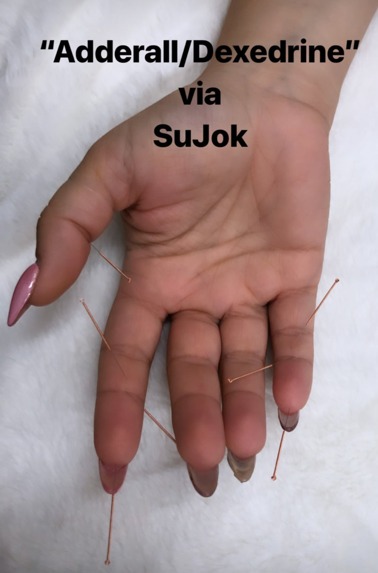  Using Sujok acupuncture treatment used for career and personal life as an alternative to traditional western medicine and diagnosis.  