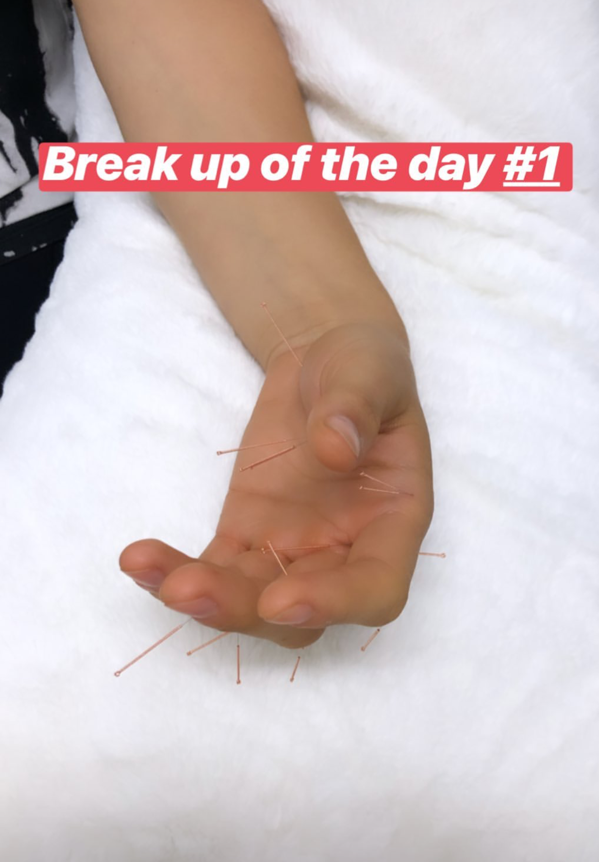  SuJok acupuncture treatment used as an alternative form of couples therapy, in this case for emotional aid in the process of a relationship breakup. 