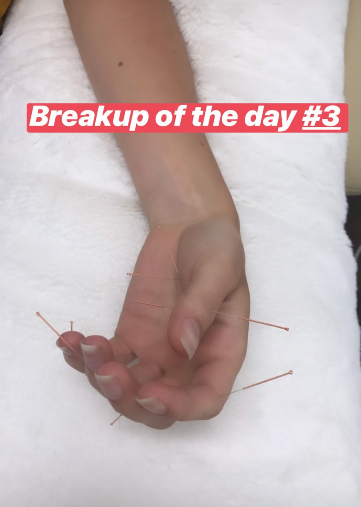  Continuation of Sujok acupuncture treatment for couples therapy, in this case third day of continuation for patient undergoing breakup 