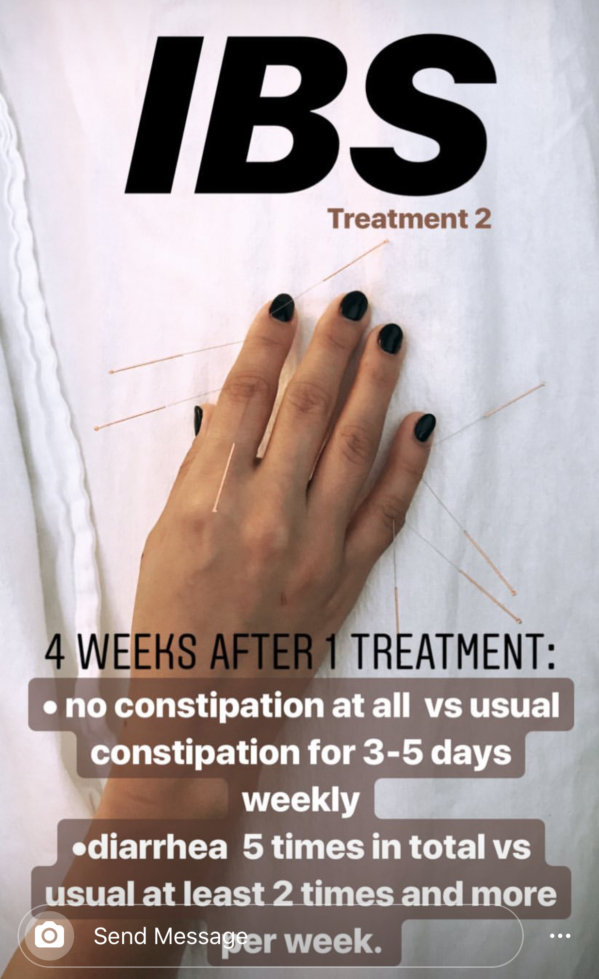  SuJok acupuncture treatment used as an alternative for digestive conditions such as Irritable Bowel Syndrome (IBS), where patient is able to reduce constipation and diarrhea after four treatment sessions 