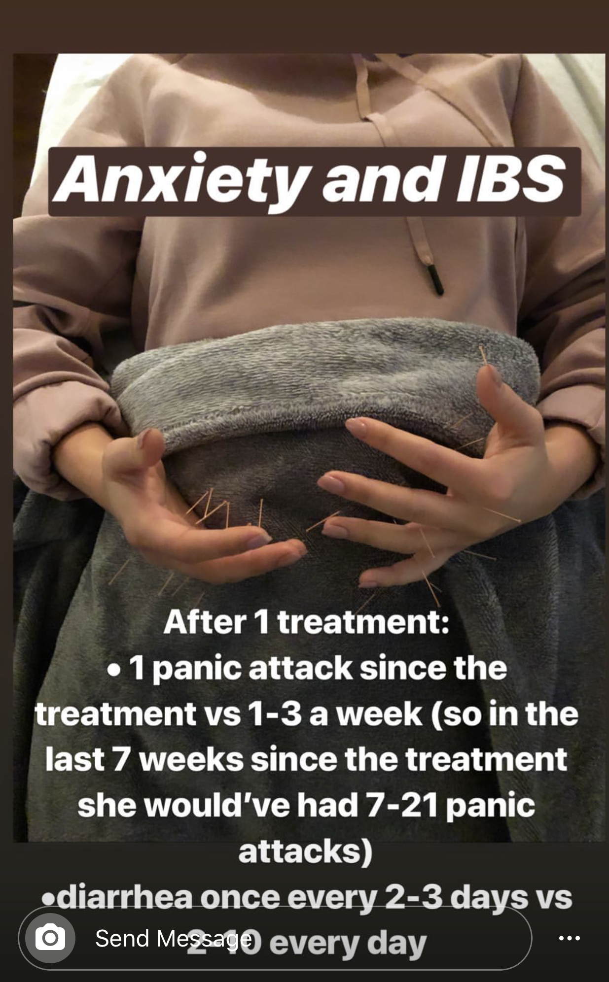  SuJok acupuncture treatment used as an alternative to digestive conditions like IBS triggered by anxiety. Treatment resulted in decrease in panic attacks and reducing diarrhea  
