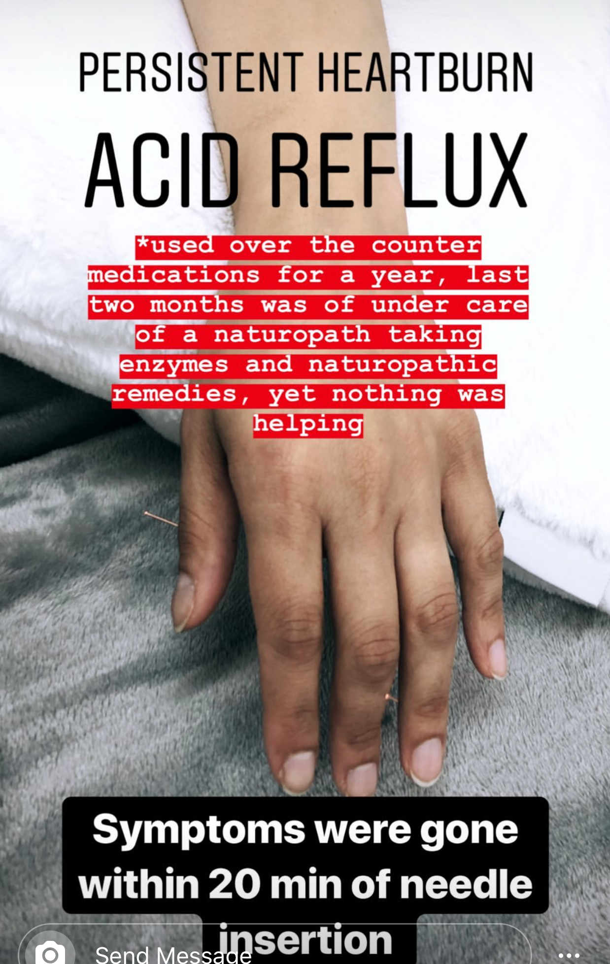  Sujok acupuncture treatment to treat digestive-related conditions and issues, in this case: strong acid reflux causing heartburn. Treatment’s effectiveness was noticed twenty minutes after needle insertion.  