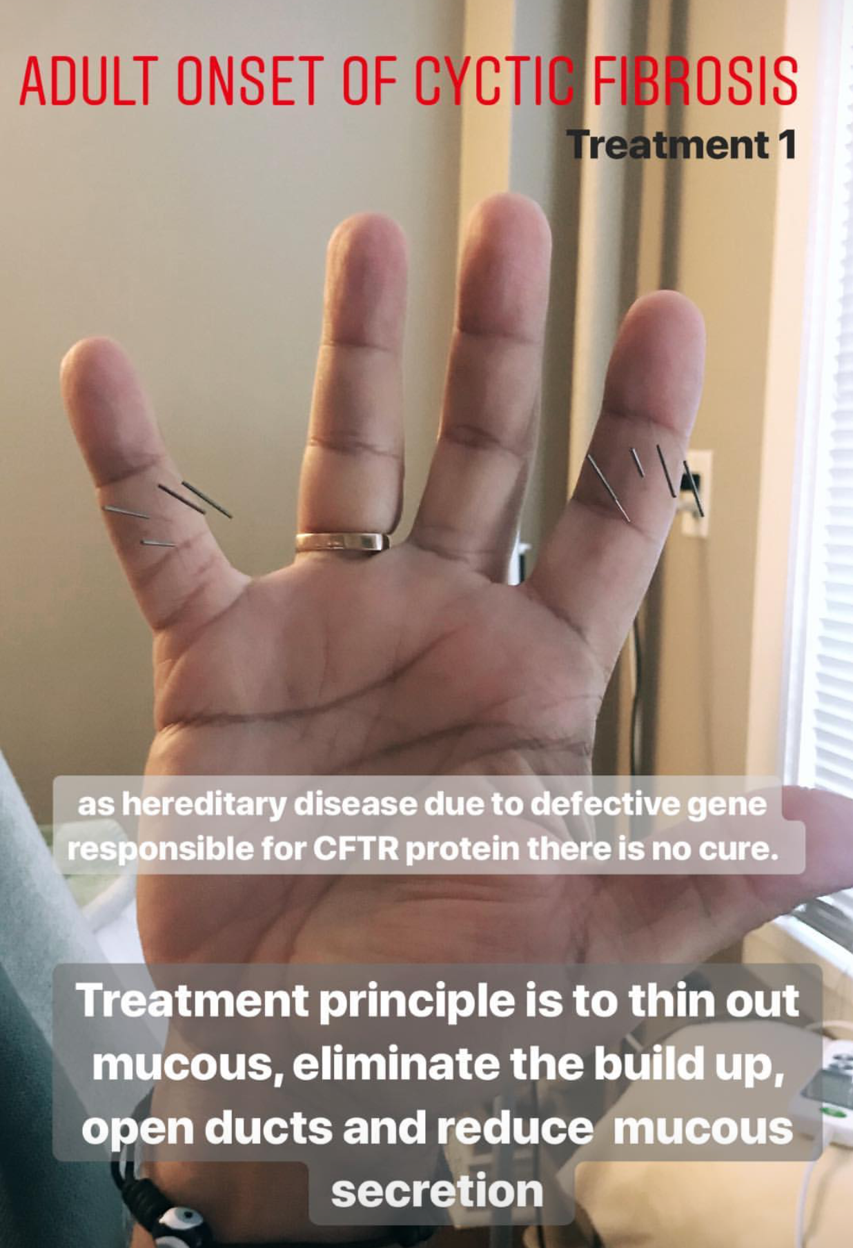  SuJok acupuncture in Vancouver treatment used for hereditary conditions and diseases, in this case: adult onset cystic fibrosis. Purpose of treatment is to reduce mucus linings, eliminate mucus build up and clear ducts for secretion reduction 