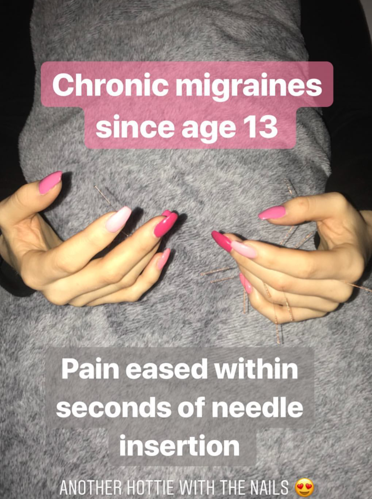  SuJok acupuncture treatment used for migraines on patient suffering from the condition since the age of 13. Treatment resulted in eased pain within seconds of needle insertion 