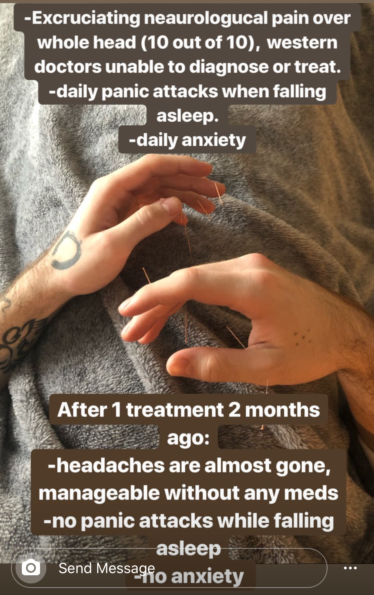  SuJok acupuncture used to treat patient with severe head pain with no medical diagnostics, recurring anxiety and panic attacks. Treatment resulted in decrease in anxiety and panic attacks, as well as a partial elimination of severe head pain 