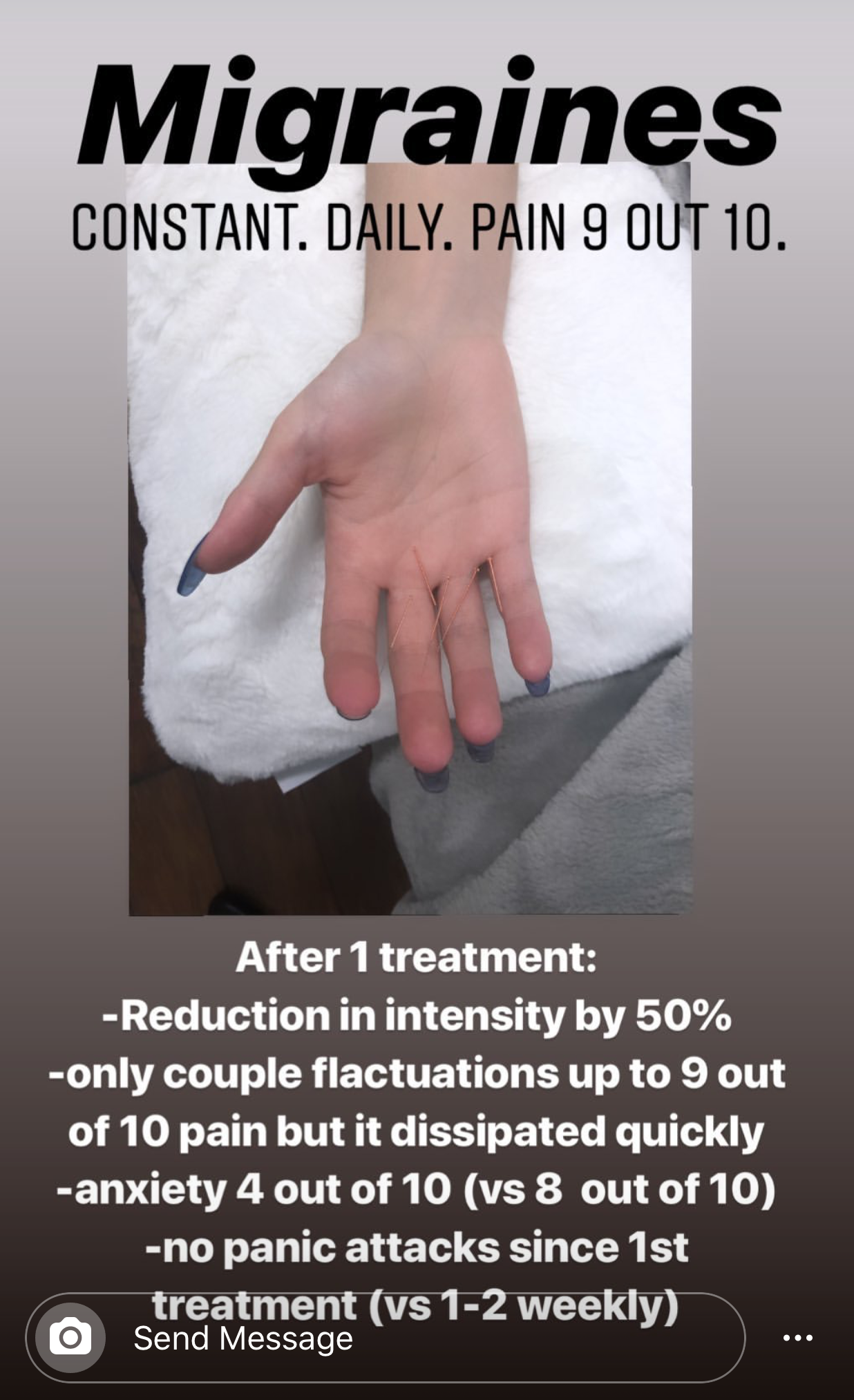  SuJok acupuncture used to treat migraines and related issues. Patient’s treatment resulted in a 50% drop in pain intensity and reduced panic/anxiety attacks in a week  