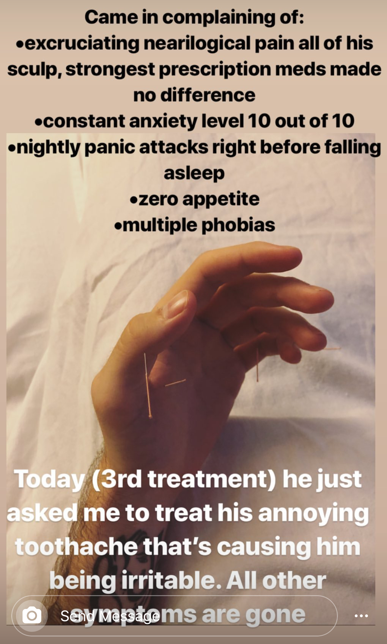  SuJok treatment used for patient with severe neurological pain (scalp) after no response to strong prescription pain medications. Condition lead to other symptoms and complications such as no appetite, nightly panic attacks, multiple phobias and anx