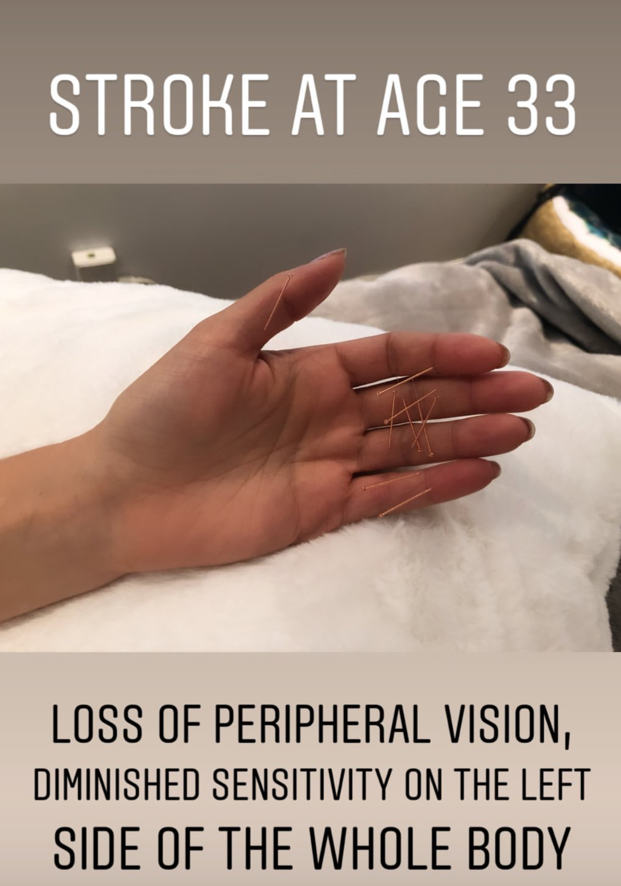  SuJok acupuncture used as treatment for neurological issues and conditions. Patient suffered a stroke at age 33, resulting in loss of peripheral vision and sensitivity on left side of the body  