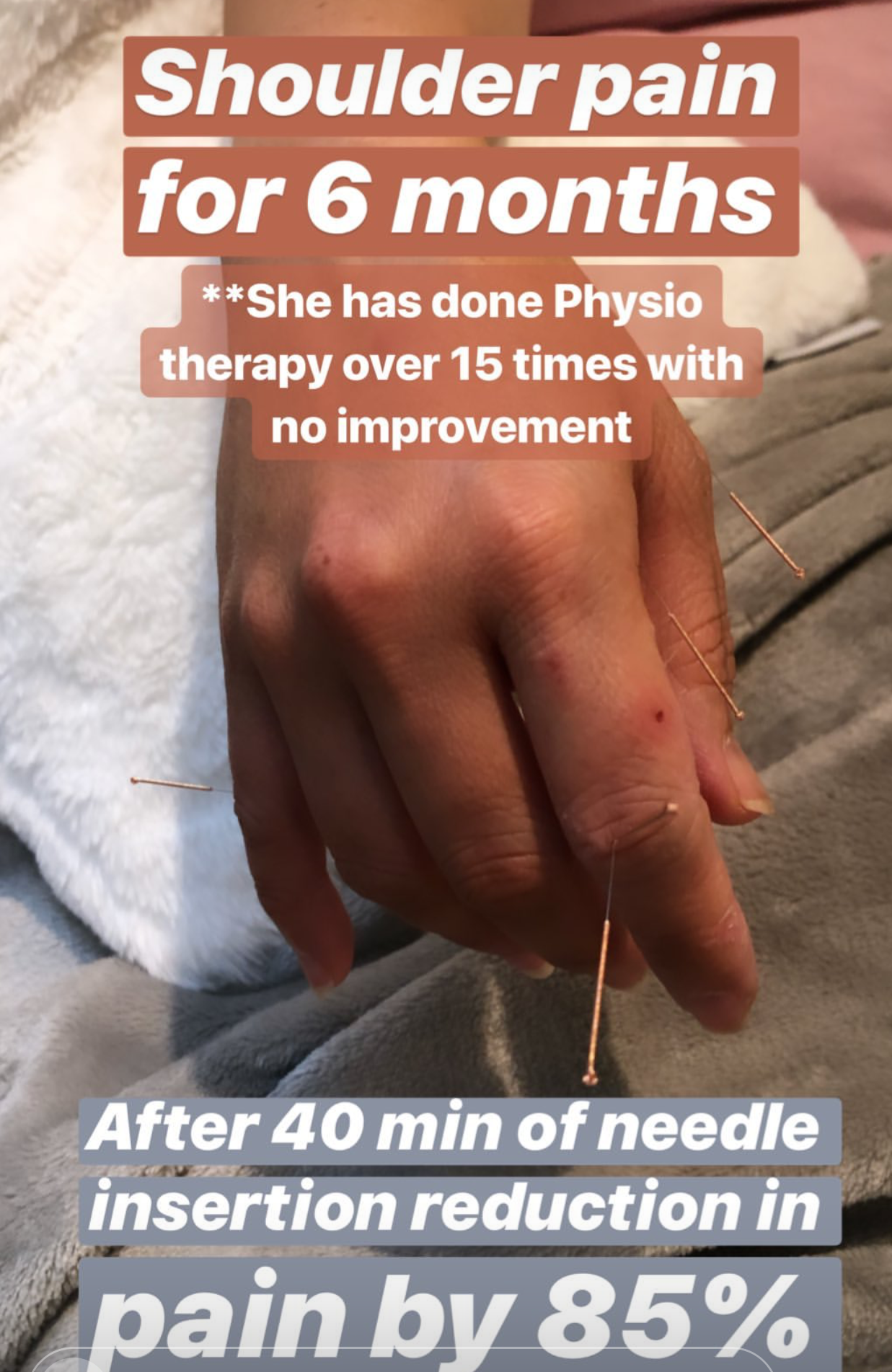  SuJok acupuncture in Vancoouver used to successfully treat patient with pain syndrome caused by the inability to move shoulder even after 6 months of unsuccessful physiotherapy. Patient was able to immediately feel 85% less pain 