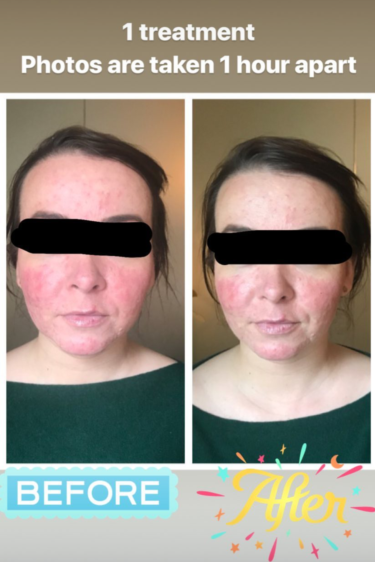 SuJok acupuncture in Vancouver used to treat skin-related issues. Improvement is significantly noticeable just one hour apart from photo capture.  