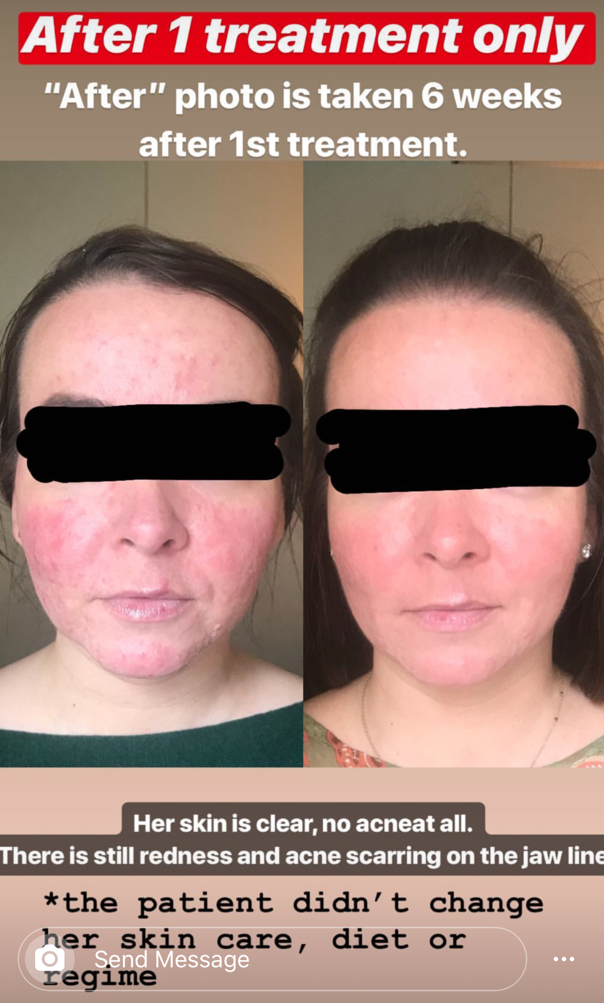  SuJok acupuncture in Vancouver used to treat skin-related issues. Patient in this case had noticeable skin improvements after only one week since first acupuncture treatment. Cleared skin was managed without diet changes, change in skincare routine 