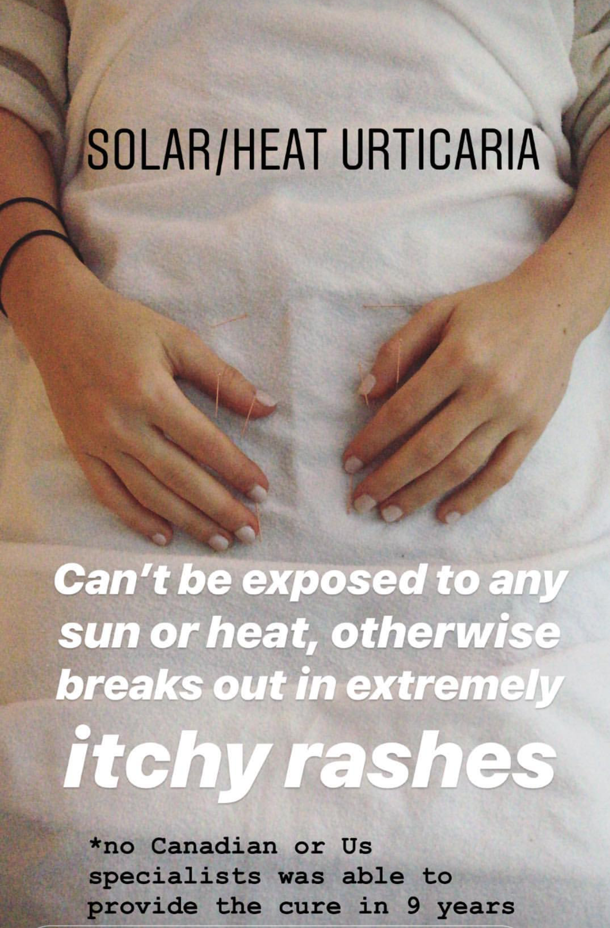  SuJok acupuncture in Vancouver used to treat patient with solar/heat Urticaria, causing skin irritation breakout when exposed to the sun .   