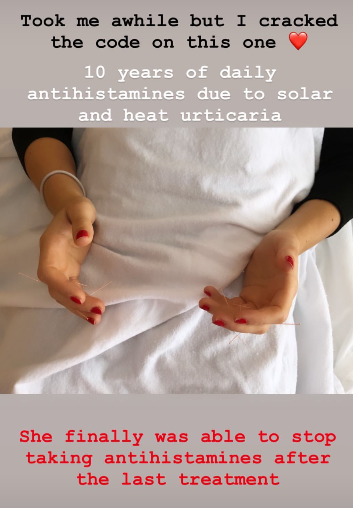  Patient taking antihistamines for solar urticaria for 10 years treated with SuJok acupuncture in Vancouver. Treatments resulted in patient eliminating need for antihistamines.  