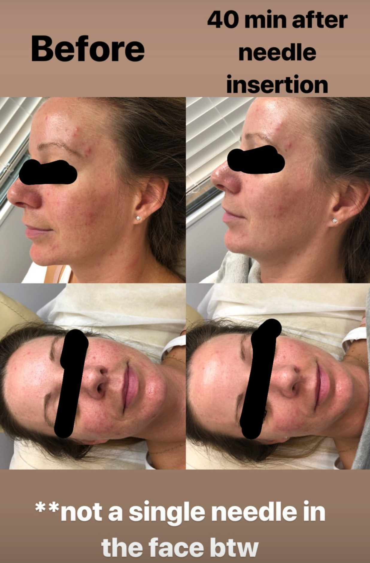  Patient treated with SuJok acupuncture for skin irritation due to acne. Patient saw immediate results after needle insertion  