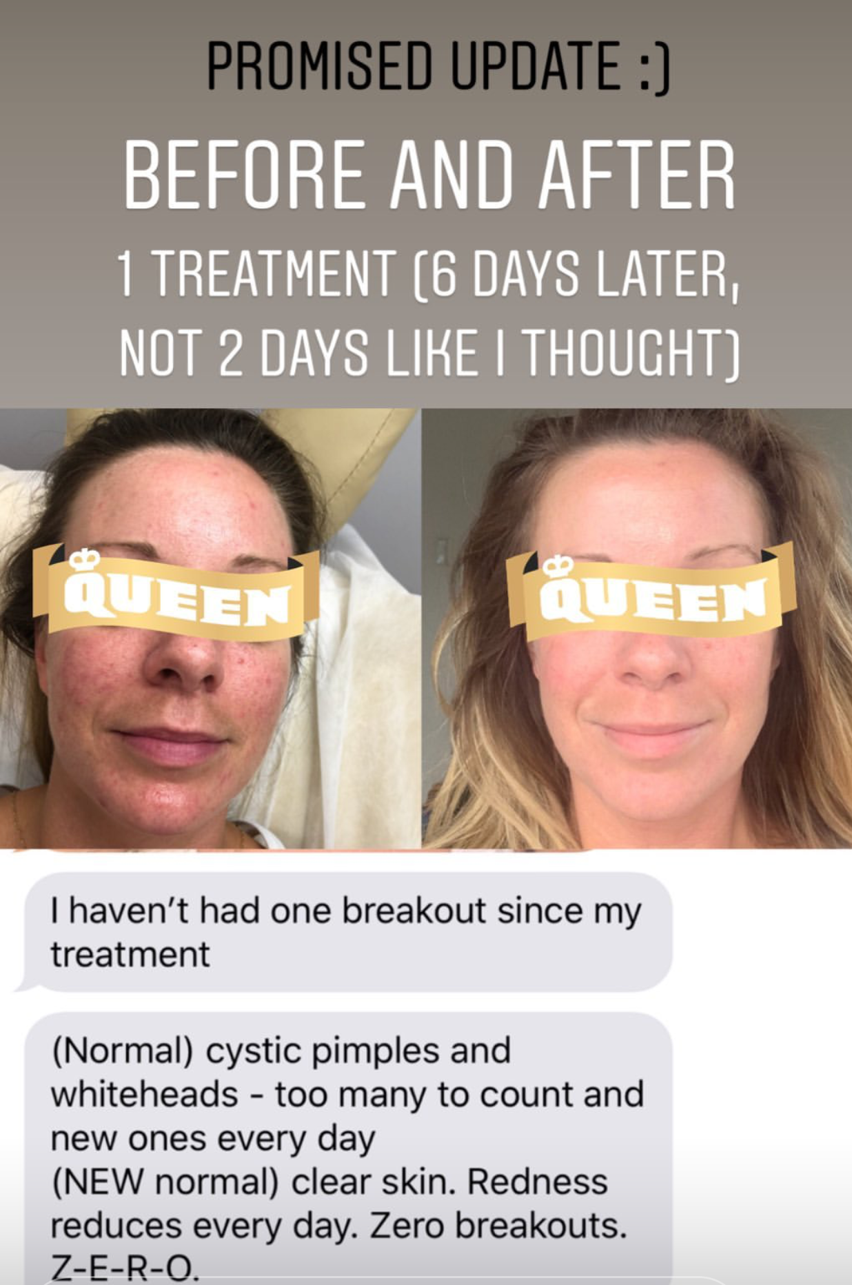  Patient treated with SuJok acupuncture for skin irritation due to acne. Patient saw immediate results after needle insertion. Patient later on expresses in text message that her skin cleared up completely after only 6 days after first treatment and 