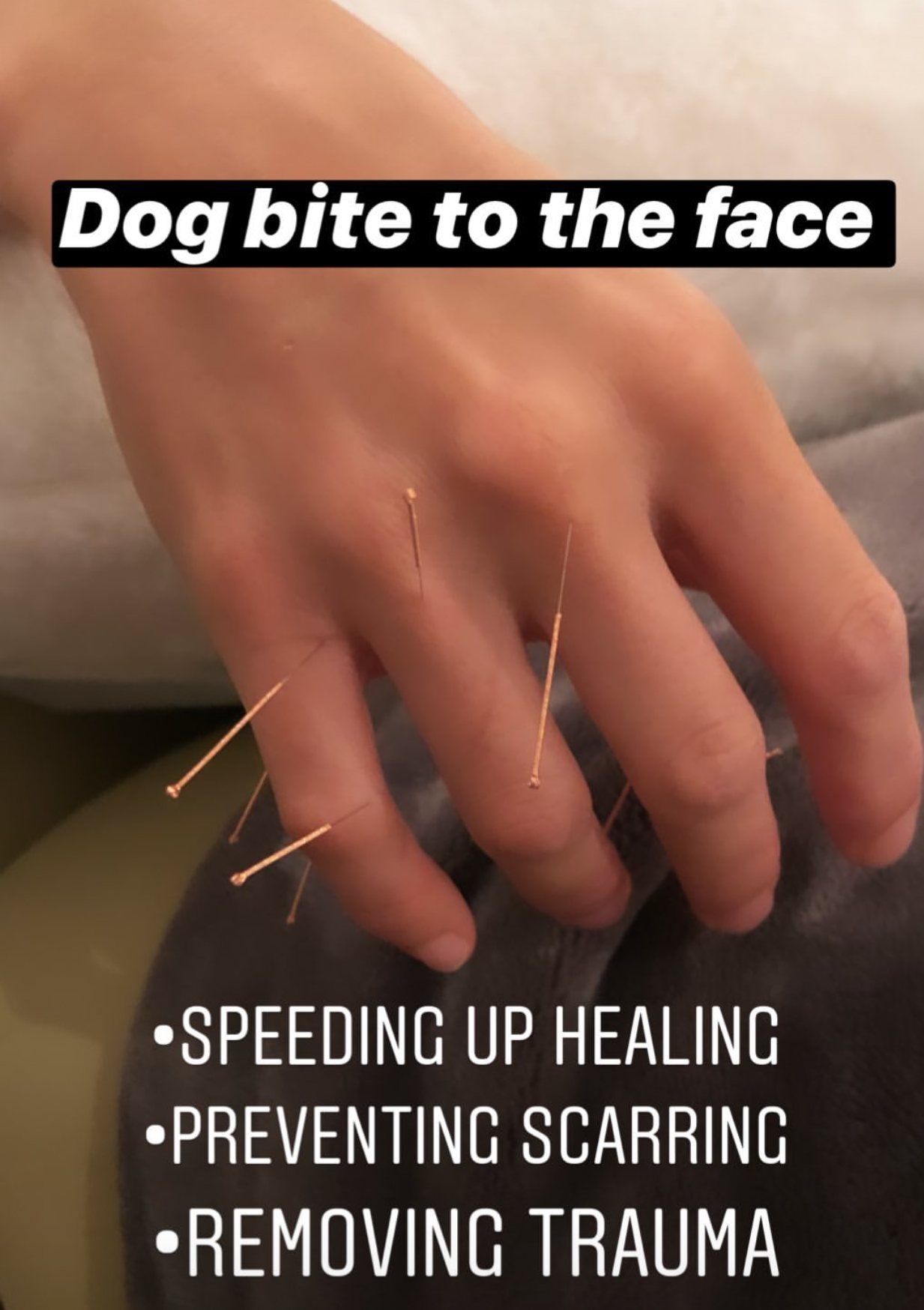  SuJok acupuncture treatment based in Vancouver used on patient who suffered a dog bite to the face. Acupuncture treatment worked to accelerate healing of the skin and prevent scarring. 