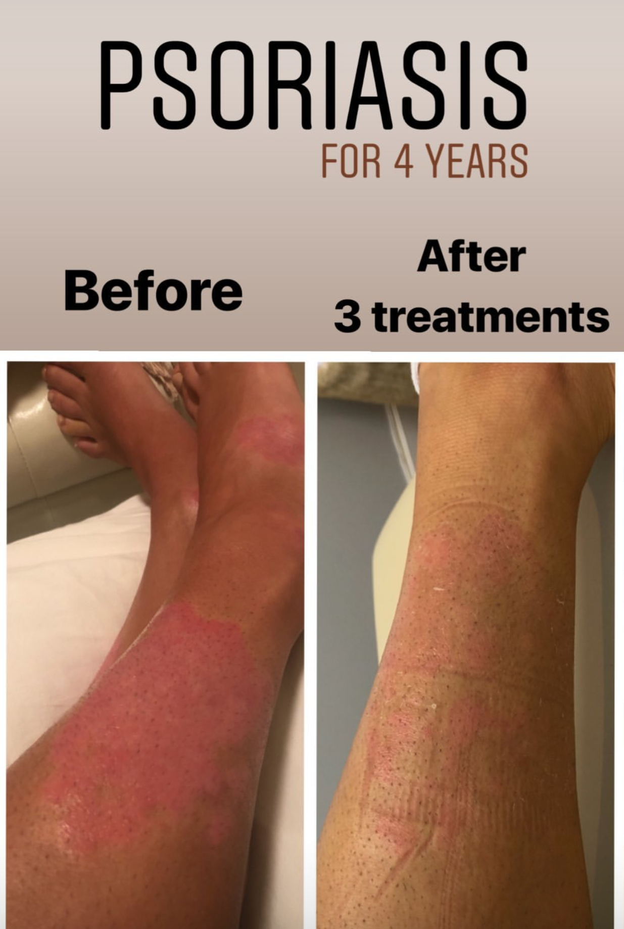 SuJok acupuncture in Vancouver used as treatment for patient suffering from skin condition, Psoriasis. Treatment resulted in reduced redness in affected areas of the skin 