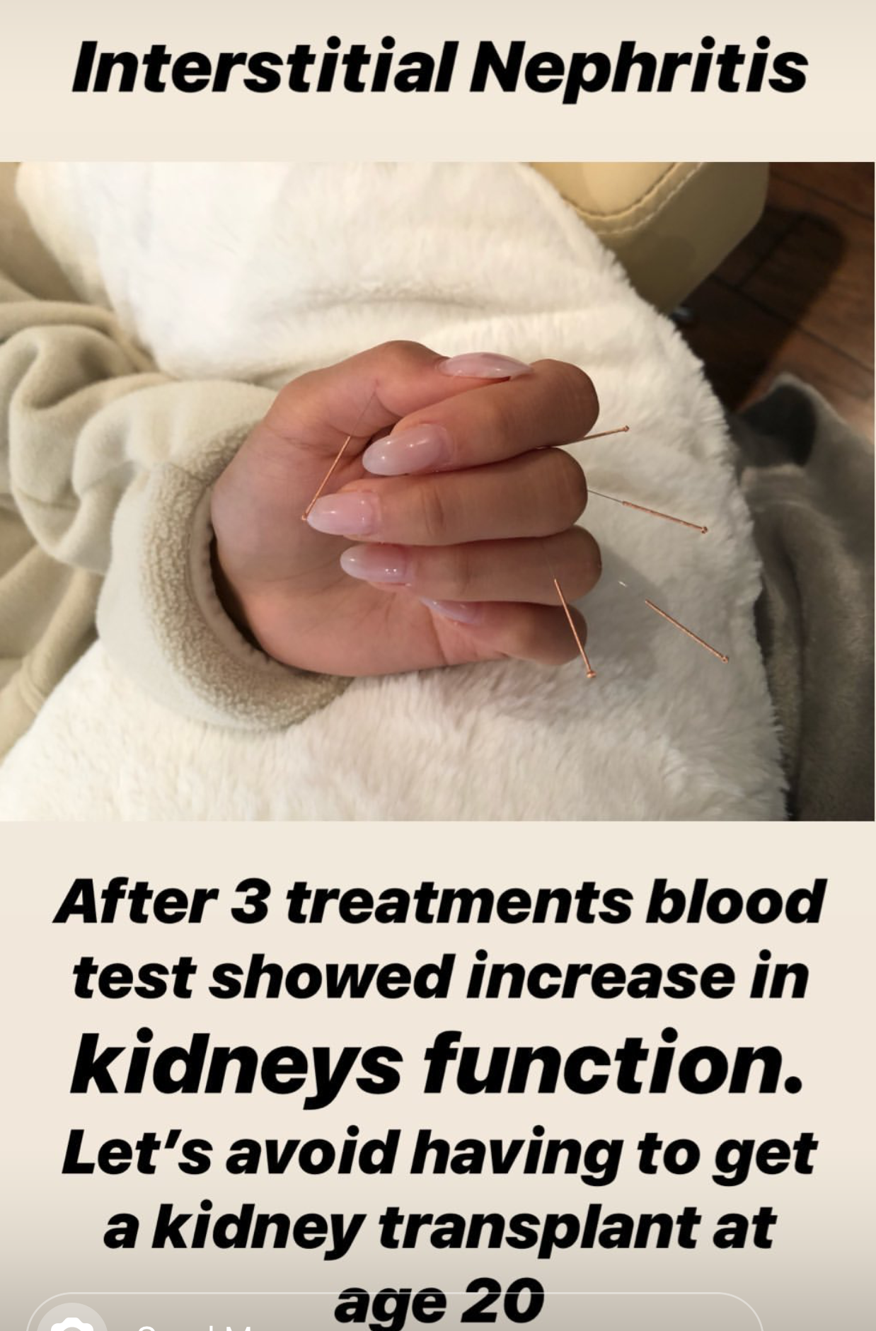  SuJok acupuncture in Vancouver used as treatment for patients with autoimmune disorders. Patient was treat for Interstitial Nephritis and showed successful results, as blood tests showed improved kidney function  