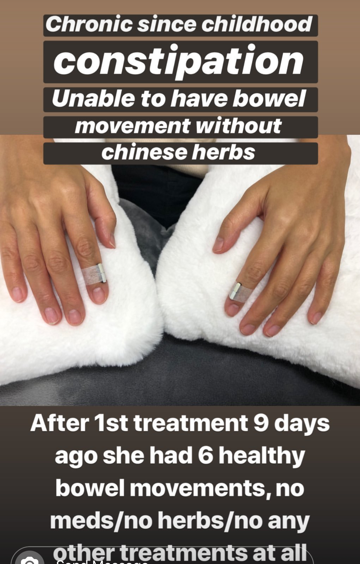  Patient treated in Vancouver with SuJok acupuncture for digestive uses. Patient was successfully treated for chronic constipation that required taking Chinese herbs for bowel movement, now was able to have healthy and natural bowel movement 