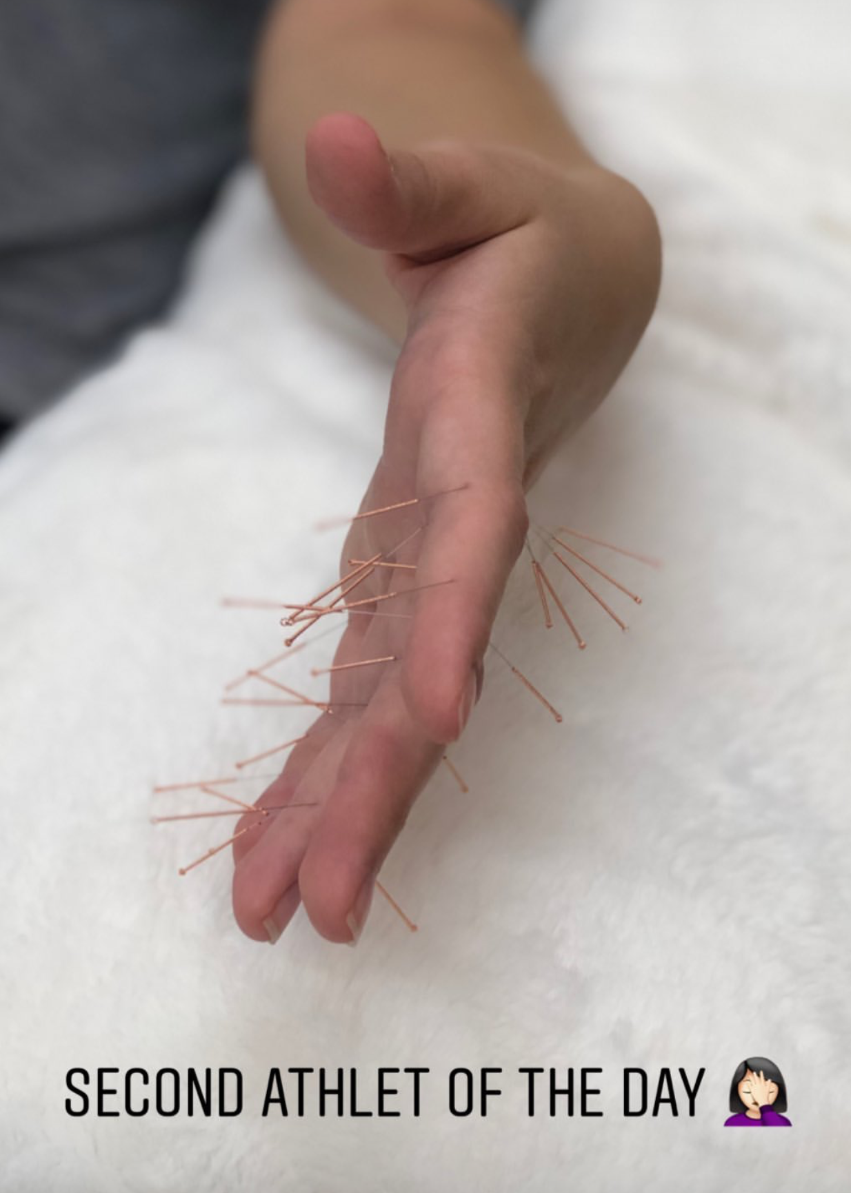  SuJok acupuncture in Vancouver used to treat athlete for sports injuries. 