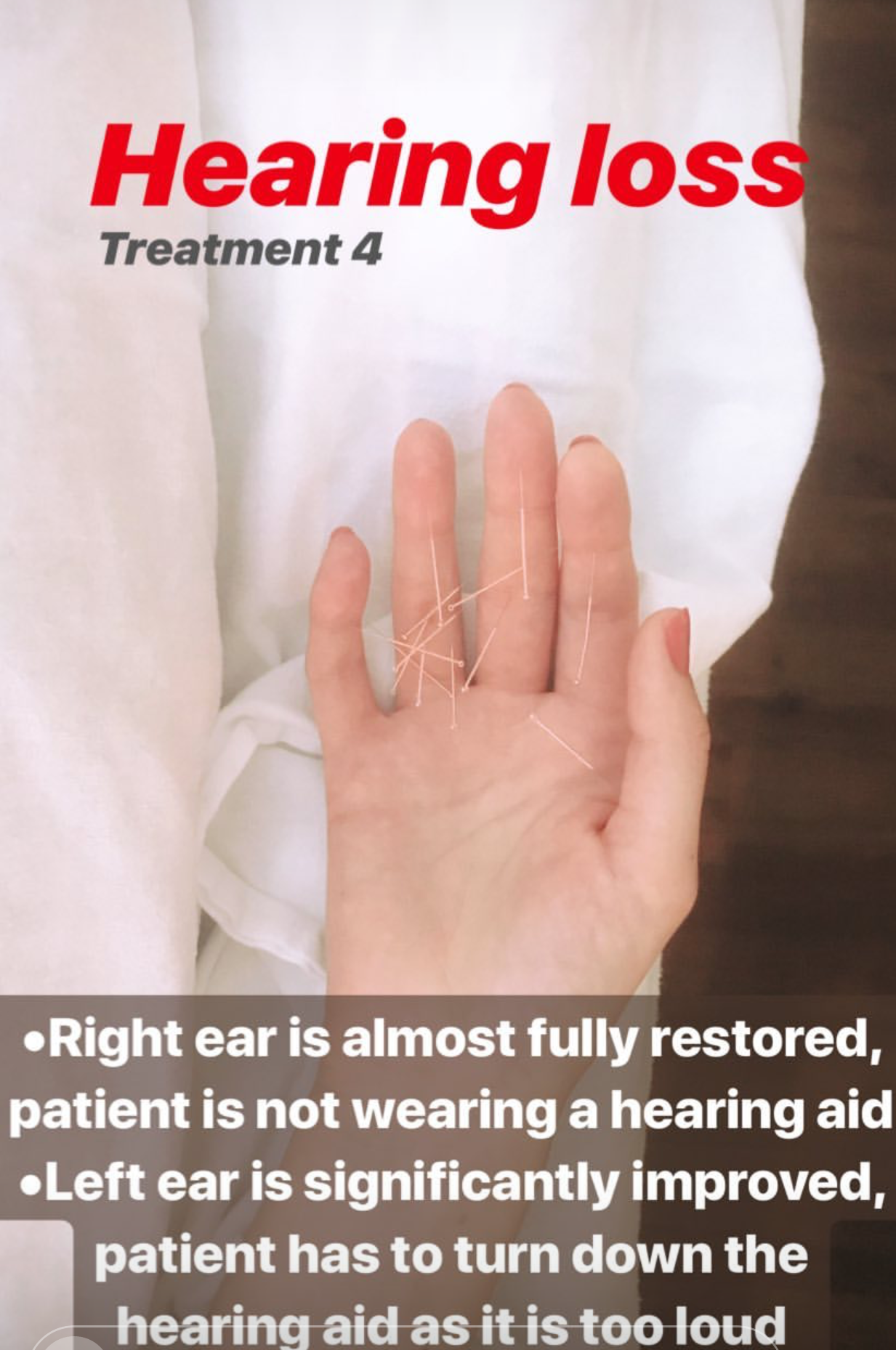  SuJok acupuncture in Vancouver used for patients with hearing problems. Patient in for her fourth  treatment was able to improve hearing by 80% 