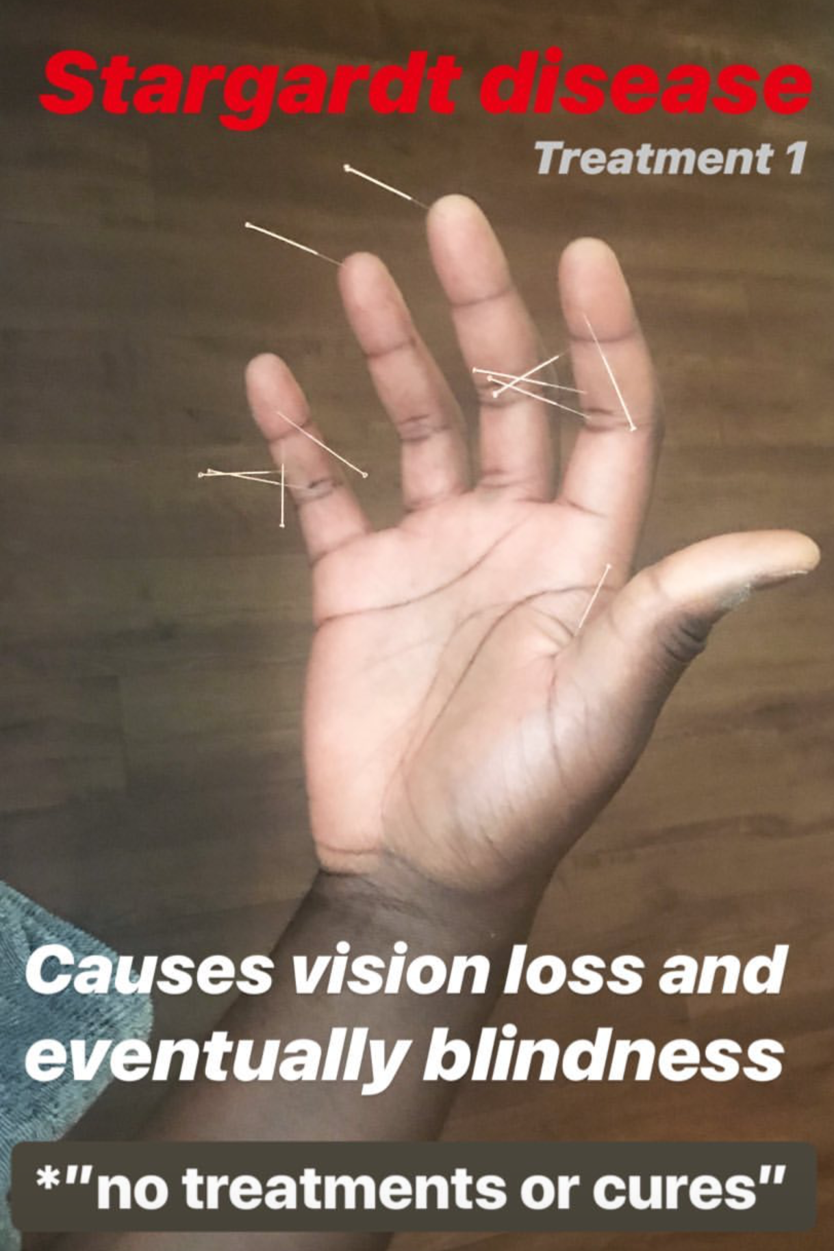  SuJok acupuncture in Vancouver used as treatment for Stargardt Disease. Patient experiencing vision loss and eventual blindness is treated with acupuncture to slow down effects 