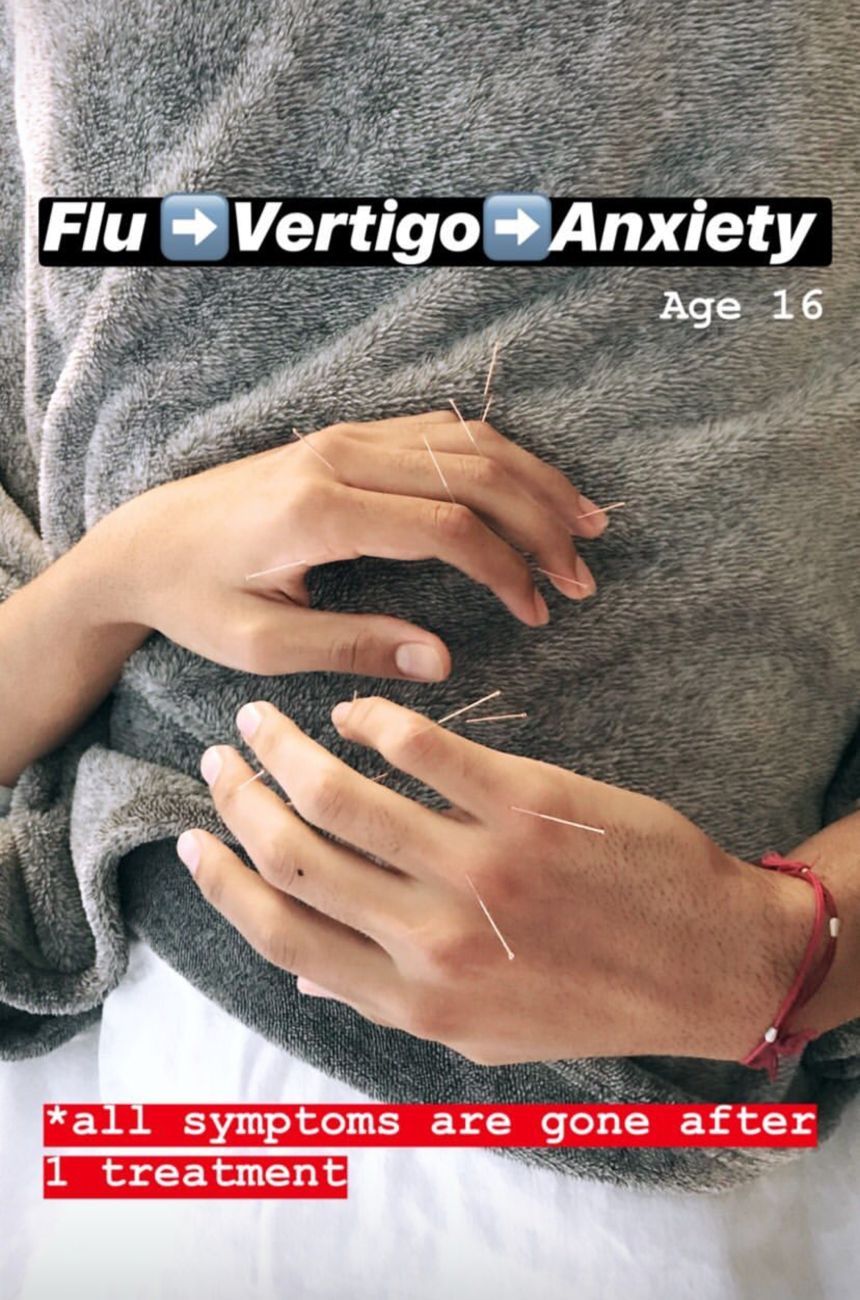  SuJok acupuncture in Vancouver used as treatment for patient with flu, vertigo and anxiety. Treatment resulted in successful elimination of all symptoms  