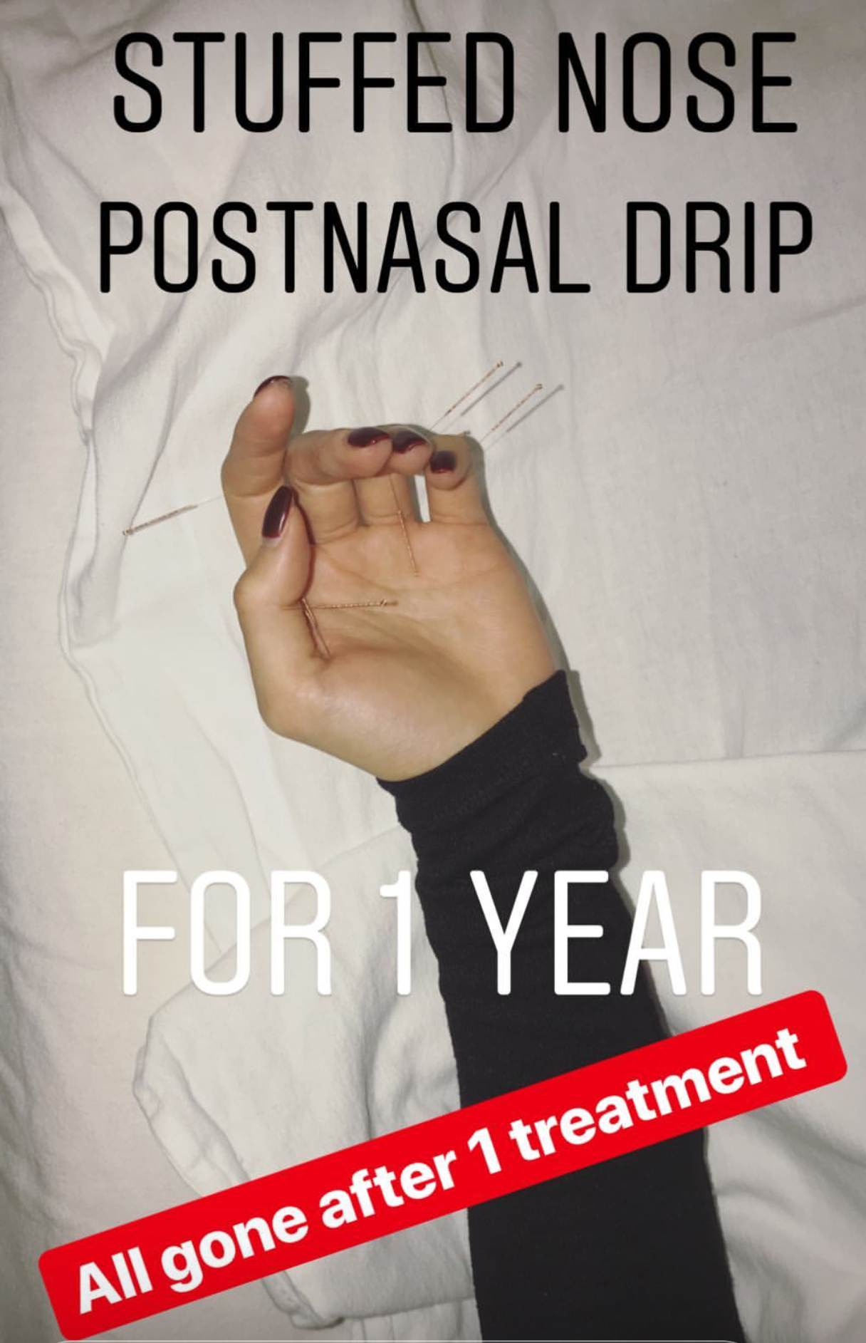  SuJok acupuncture in Vancouver treated for postnasal drip of one year. Treatment results in successful elimination of drip 