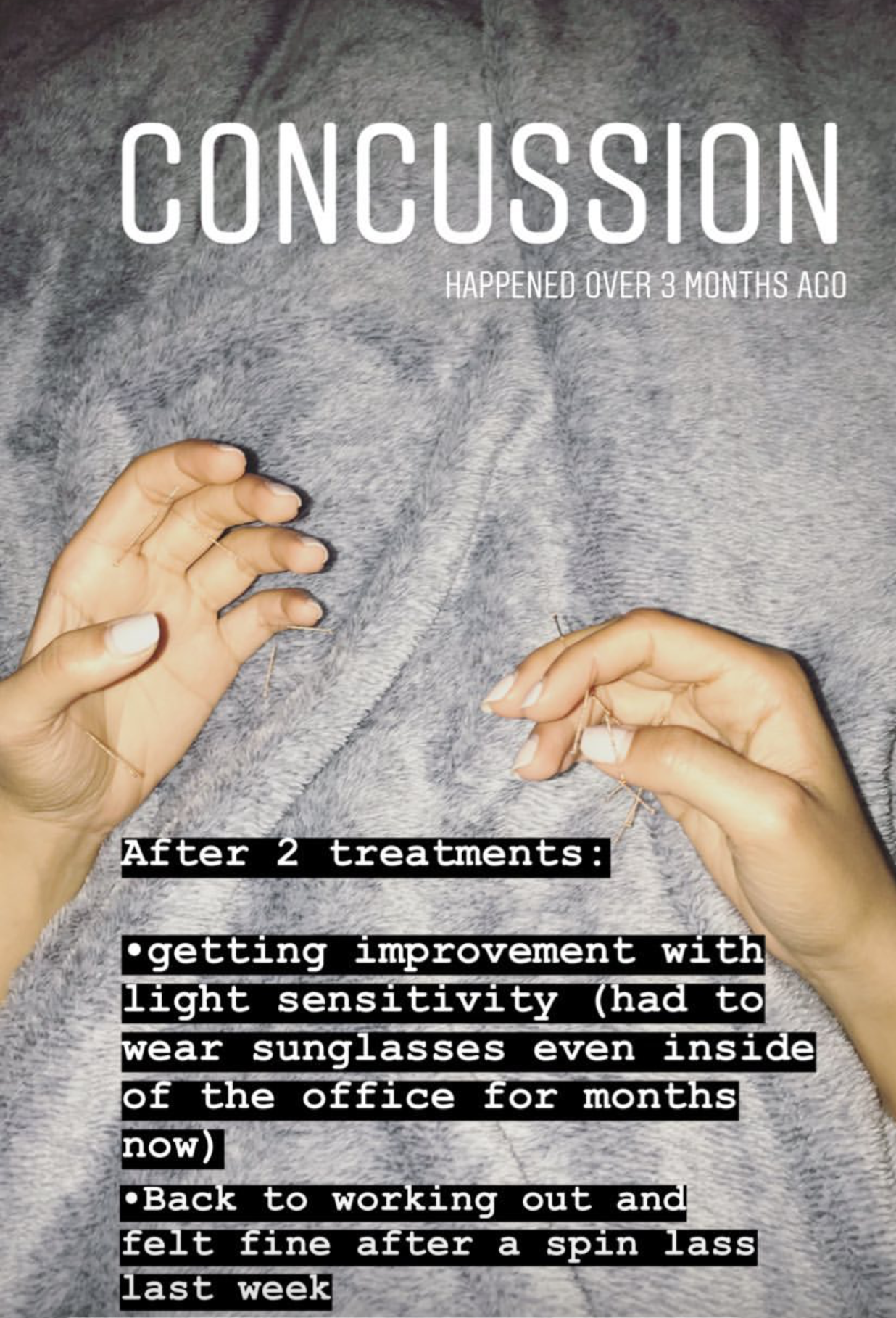  SuJok acupuncture in Vancouver used on patient with severe light sensitivity due to a concussion. Treatment was successful and resulted in reduction of light sensitivity and ability to go back to work 