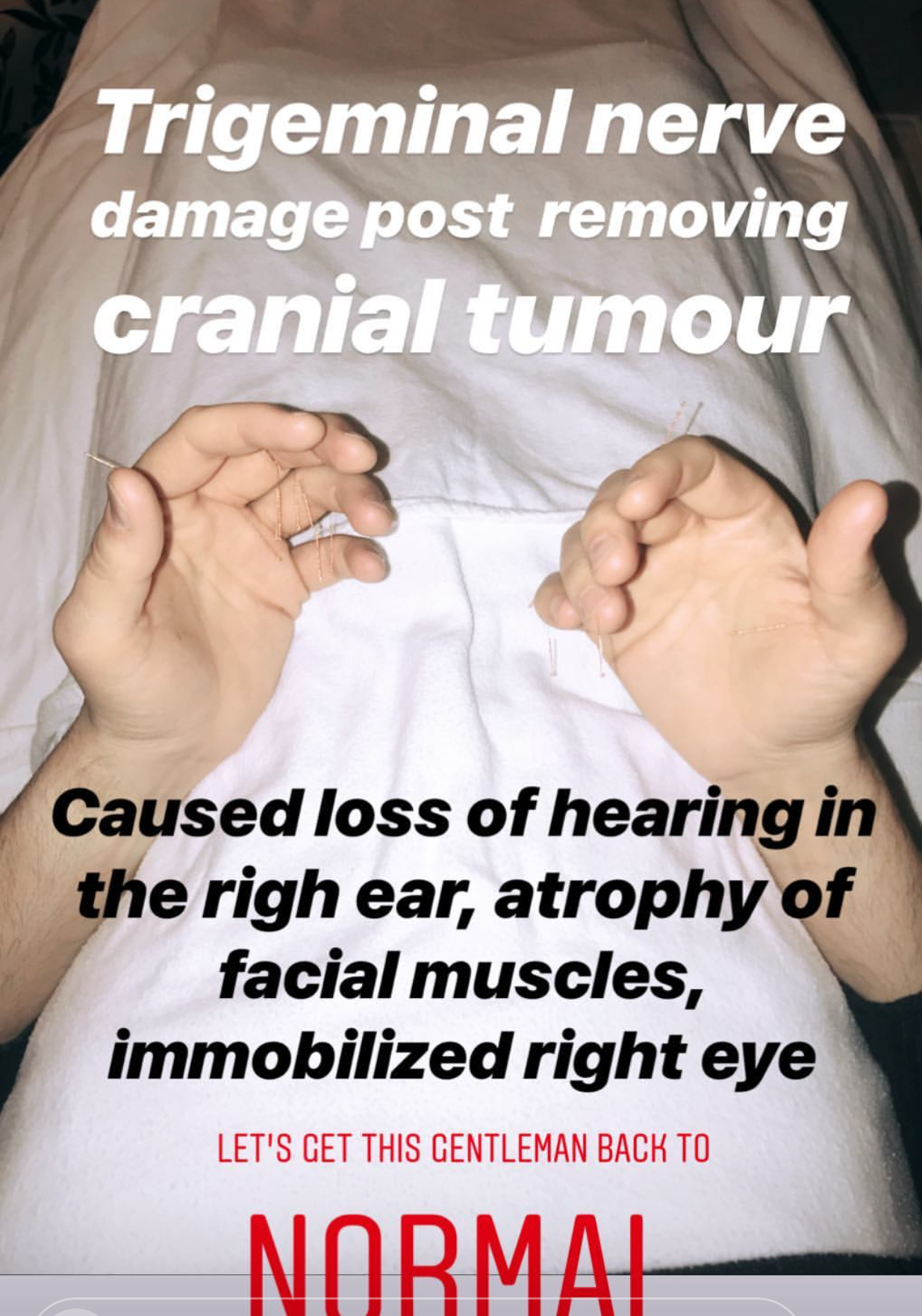  SuJok acupuncture in Vancouver used to treat patient with trigeminal nerve damage due to cranial tumor surgery. Patient suffered from partial hearing loss, atrophy of facial muscles and inability to move right eye.  