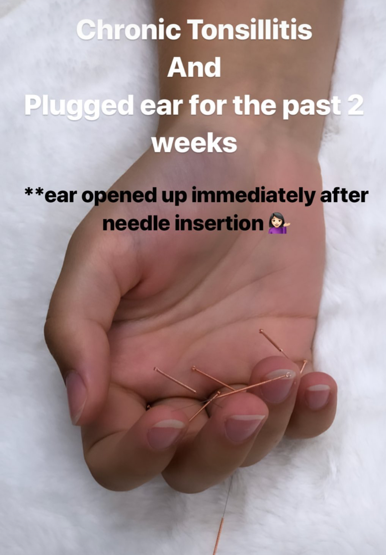  SuJok acupuncture in Vancouver used as treatment for patient with chronic tonsilitis and clogged ears. Treatment results in immediate relief in ears. 